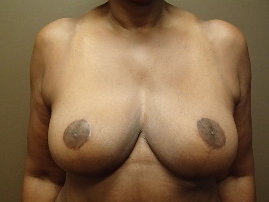 Cosmetic Breast Reduction After