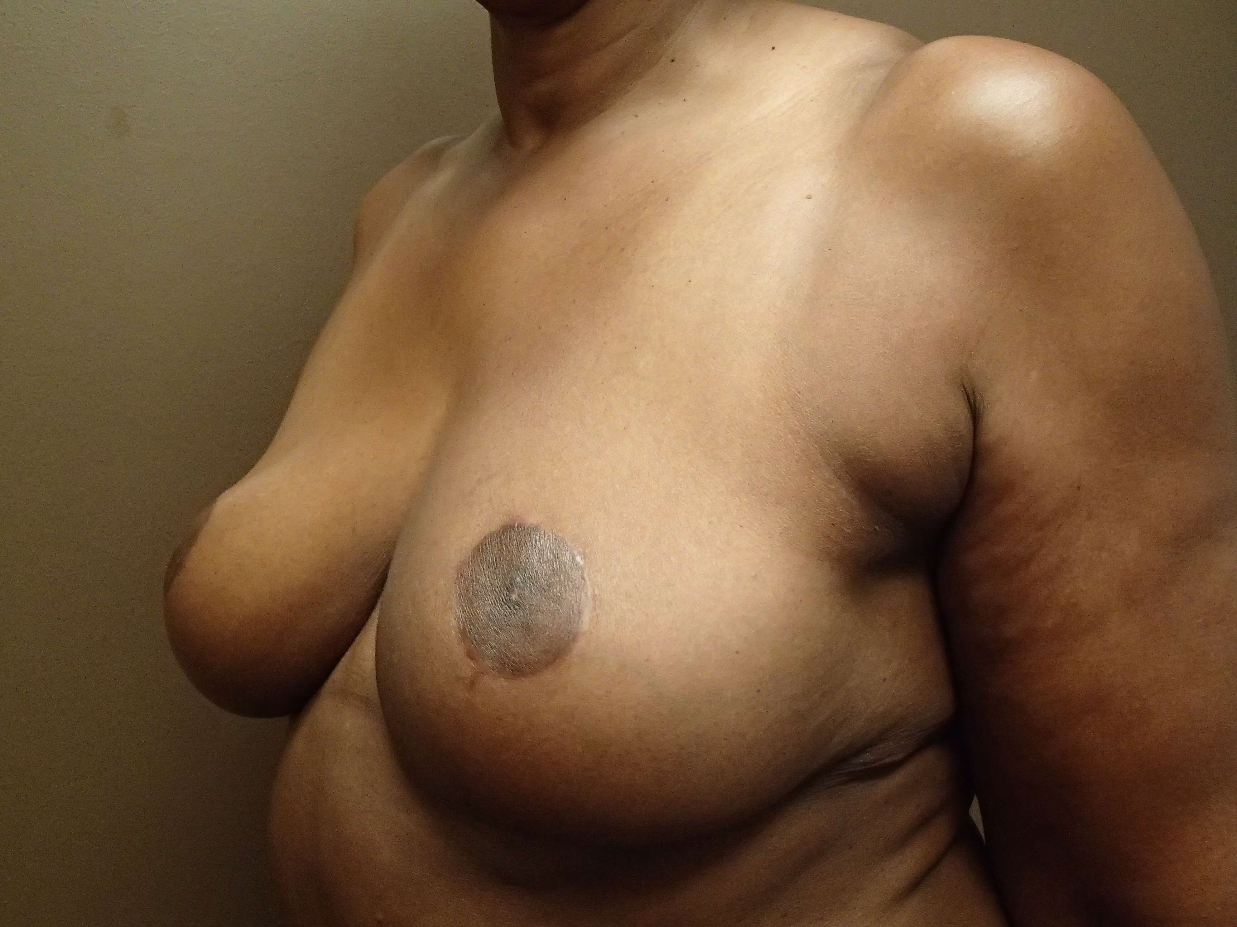 Cosmetic Breast Reduction After