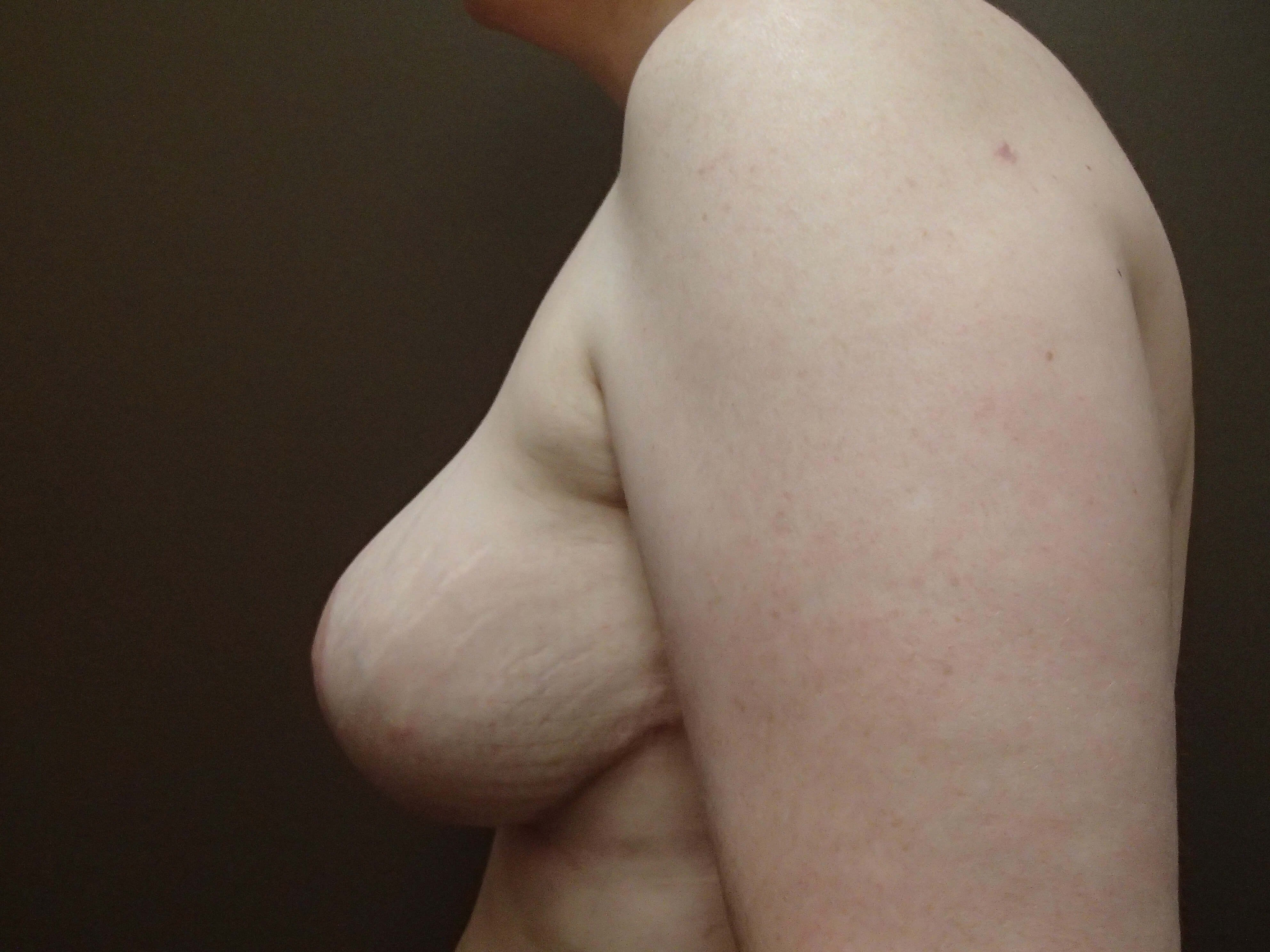 Cosmetic Breast Reduction After