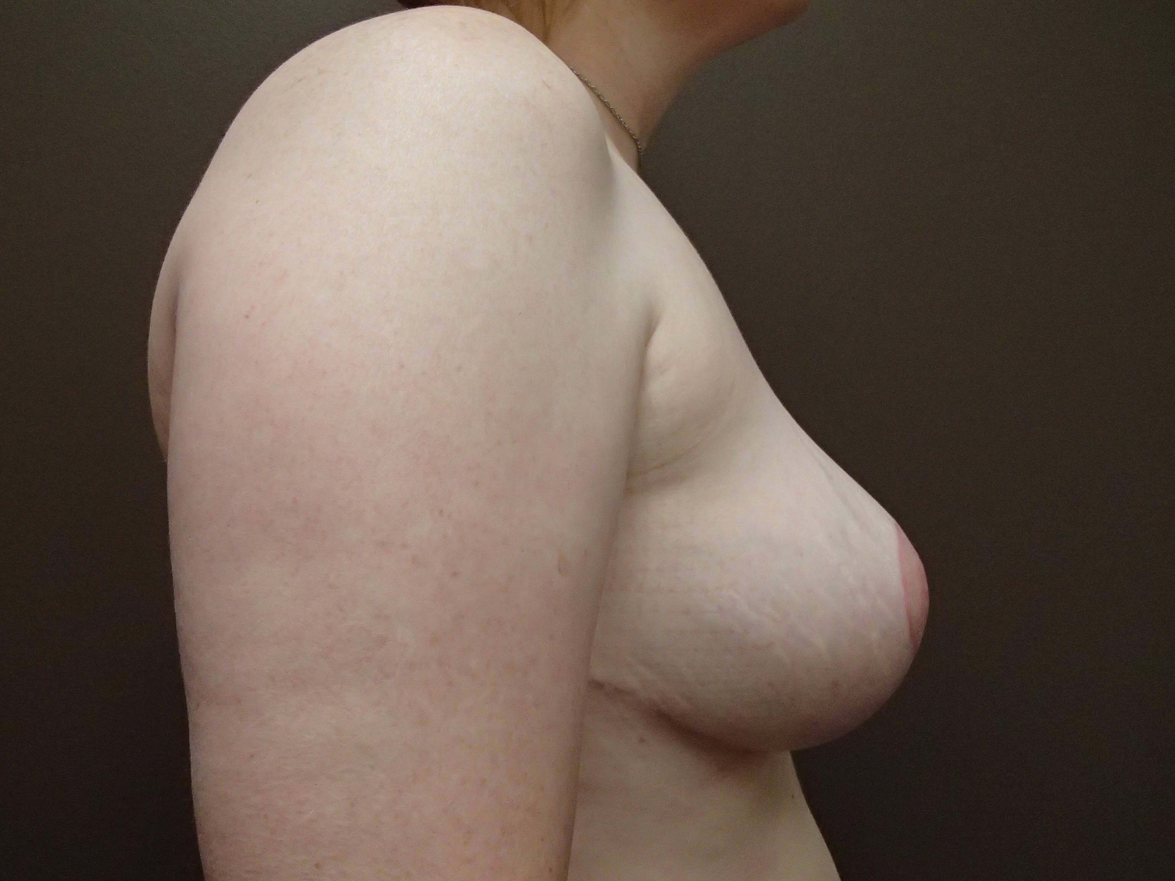 Cosmetic Breast Reduction After