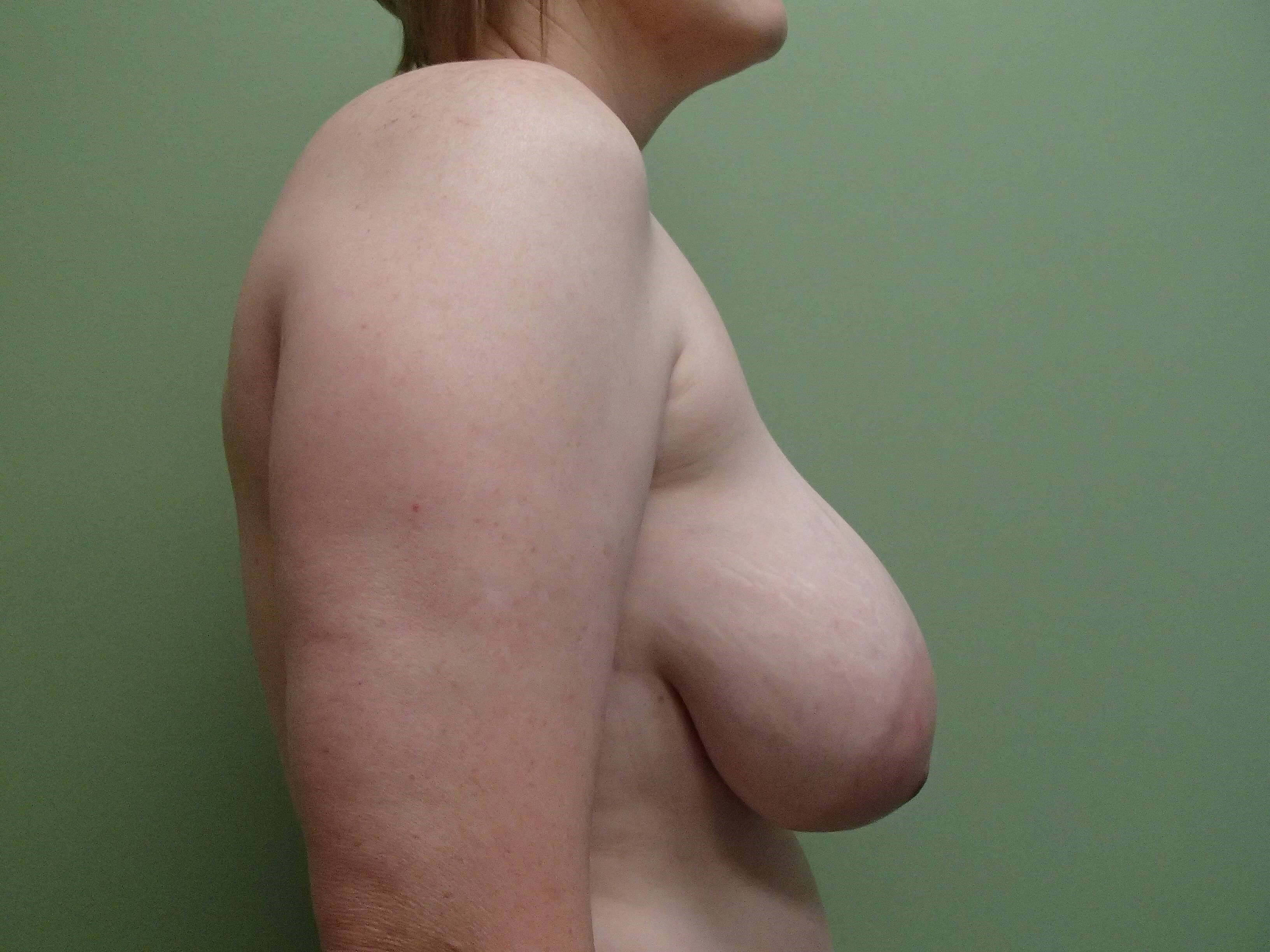 Cosmetic Breast Reduction Before