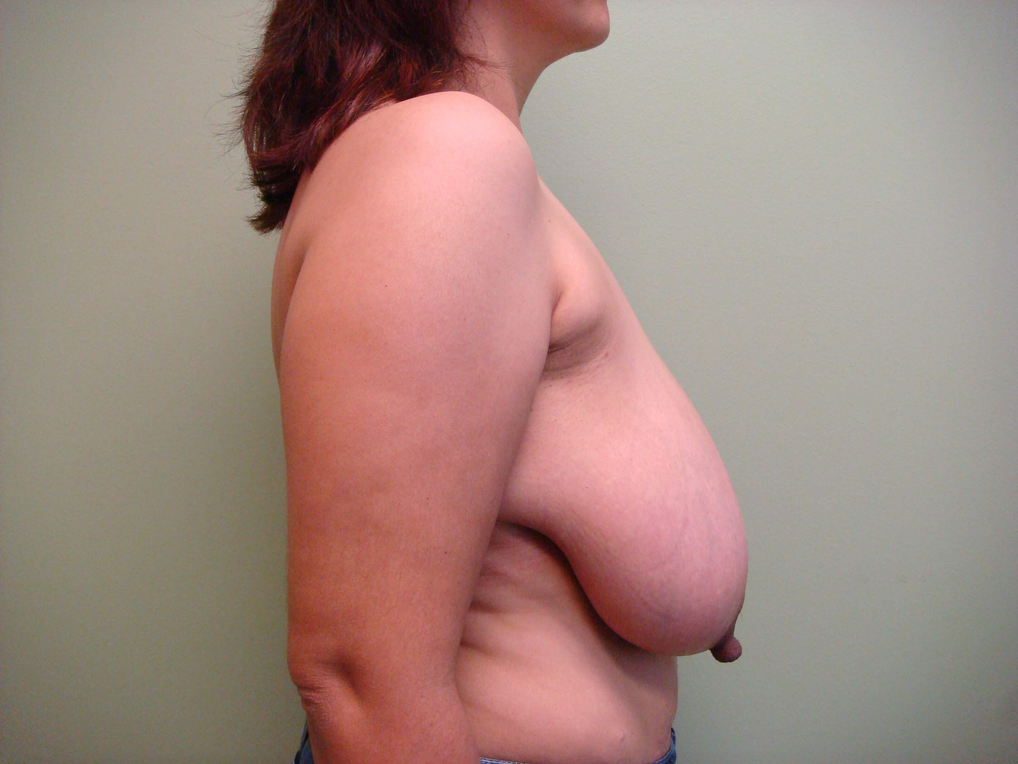 Cosmetic Breast Reduction Before