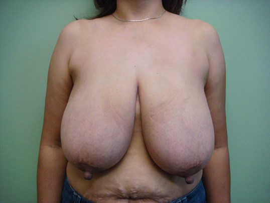 Cosmetic Breast Reduction Before