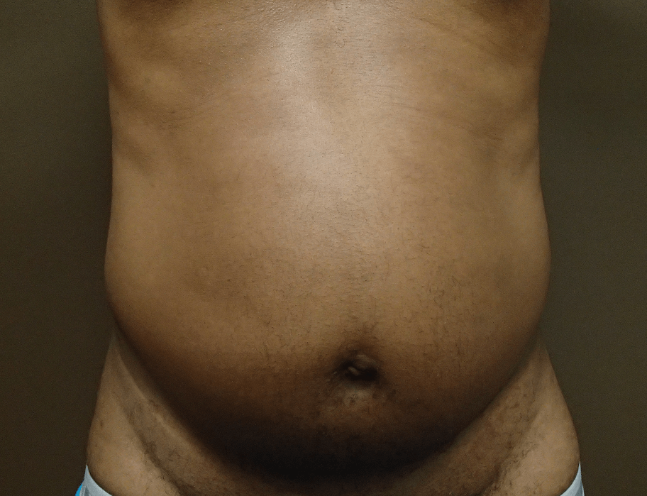 Abdominoplasty and Liposuction Before