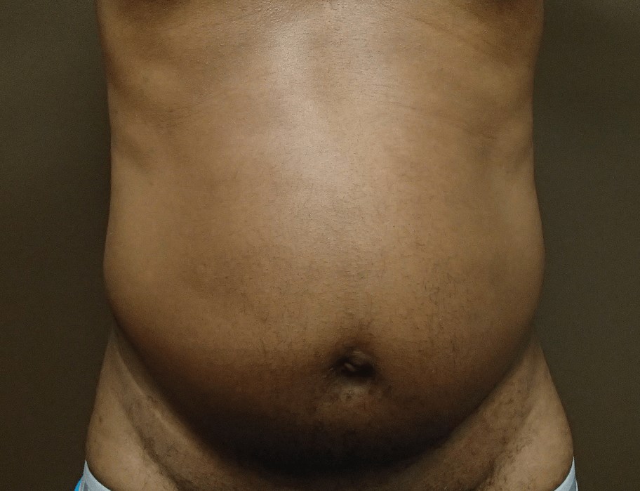Abdominoplasty and Liposuction Before