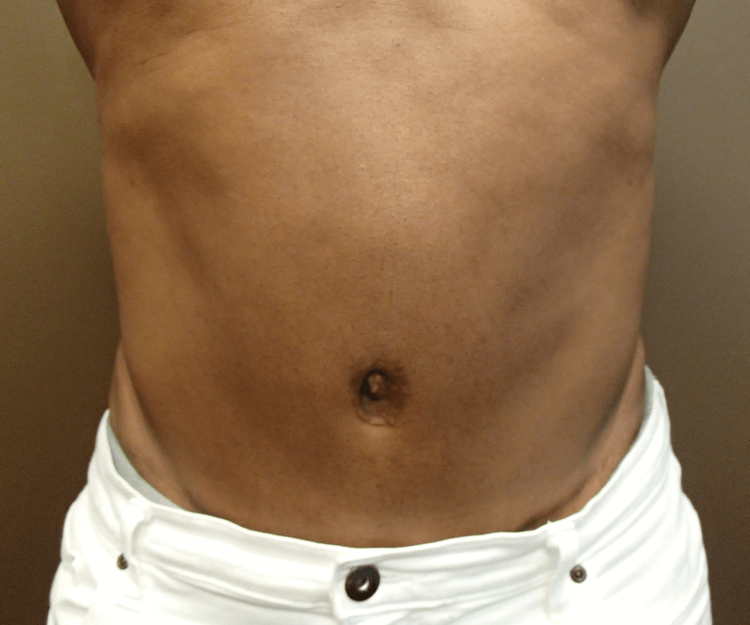 Abdominoplasty and Liposuction After