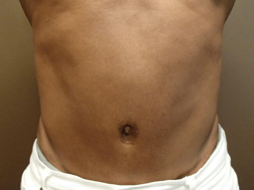 Abdominoplasty and Liposuction After