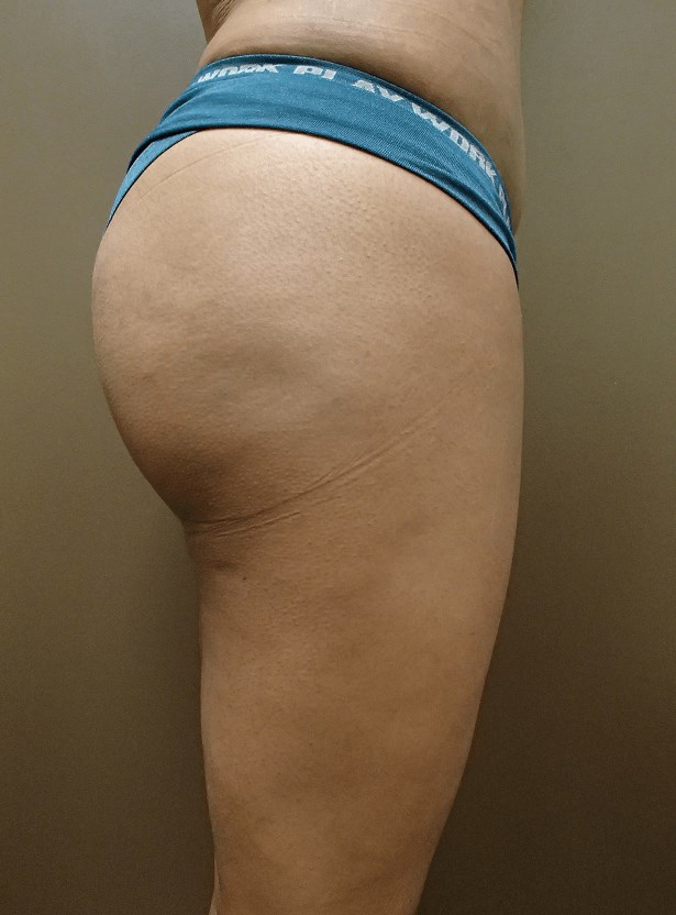 Auto Fat to Buttocks After