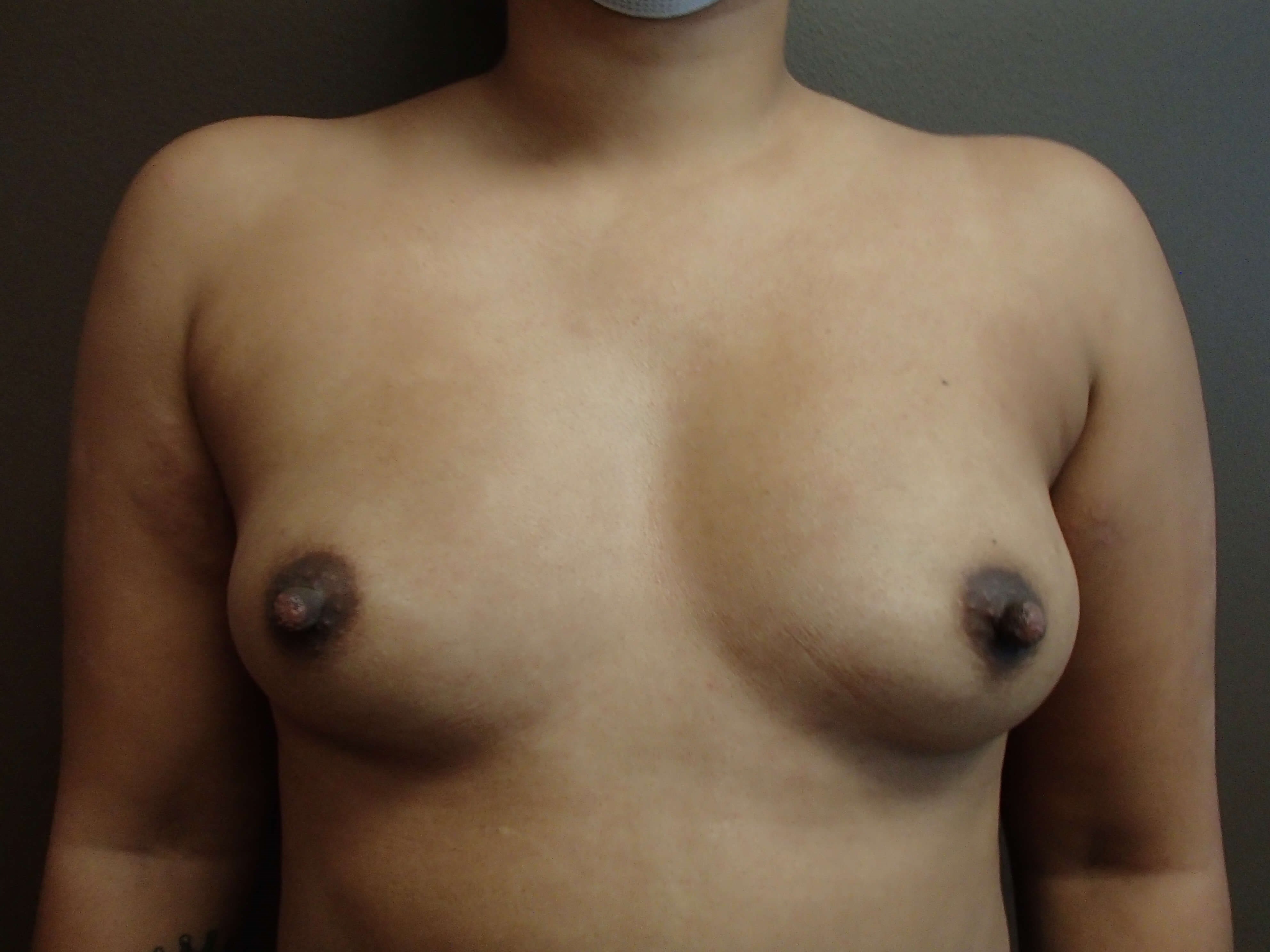 Breast Augmentation Before