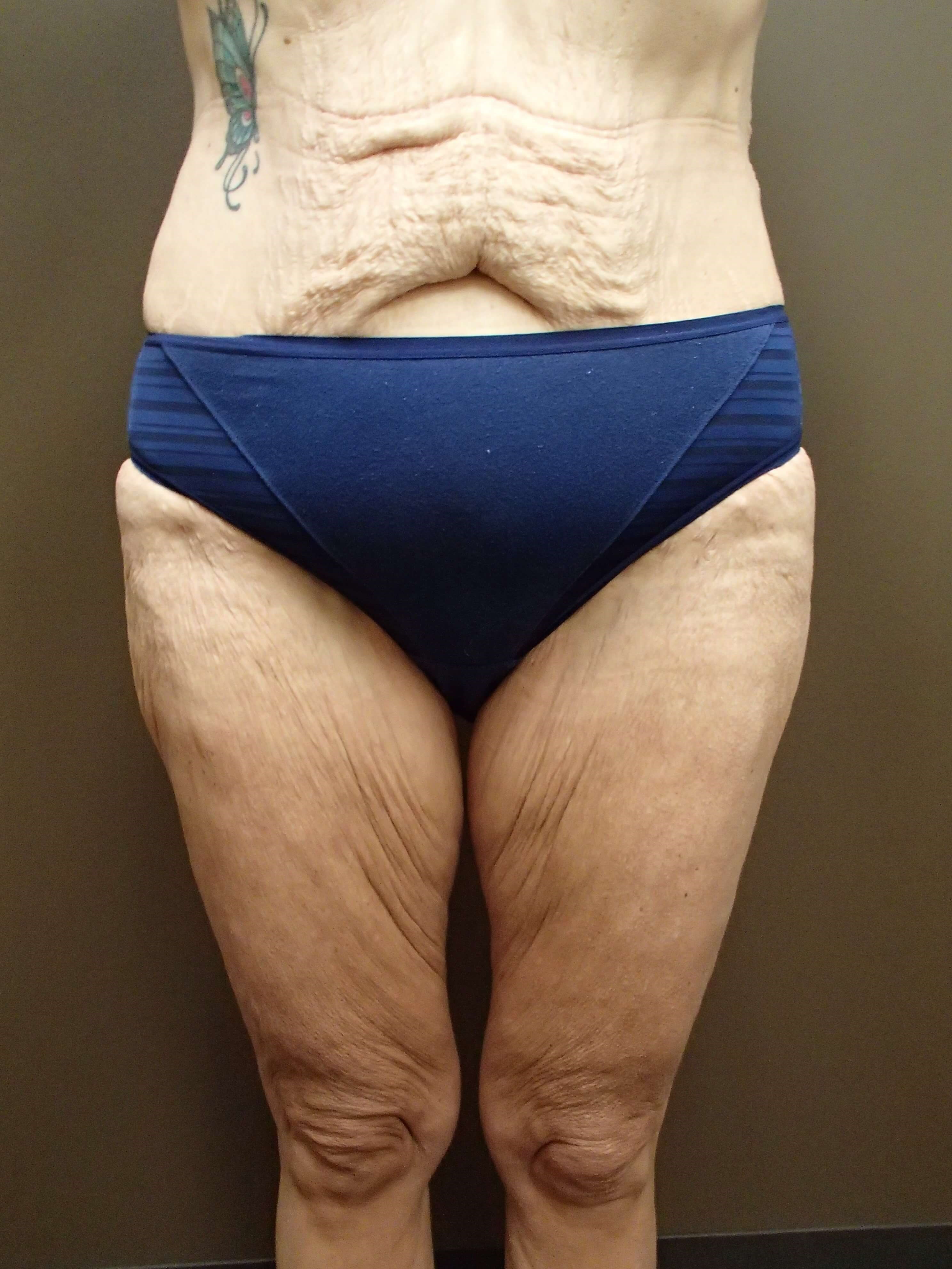 Outer Thigh Liposuction After