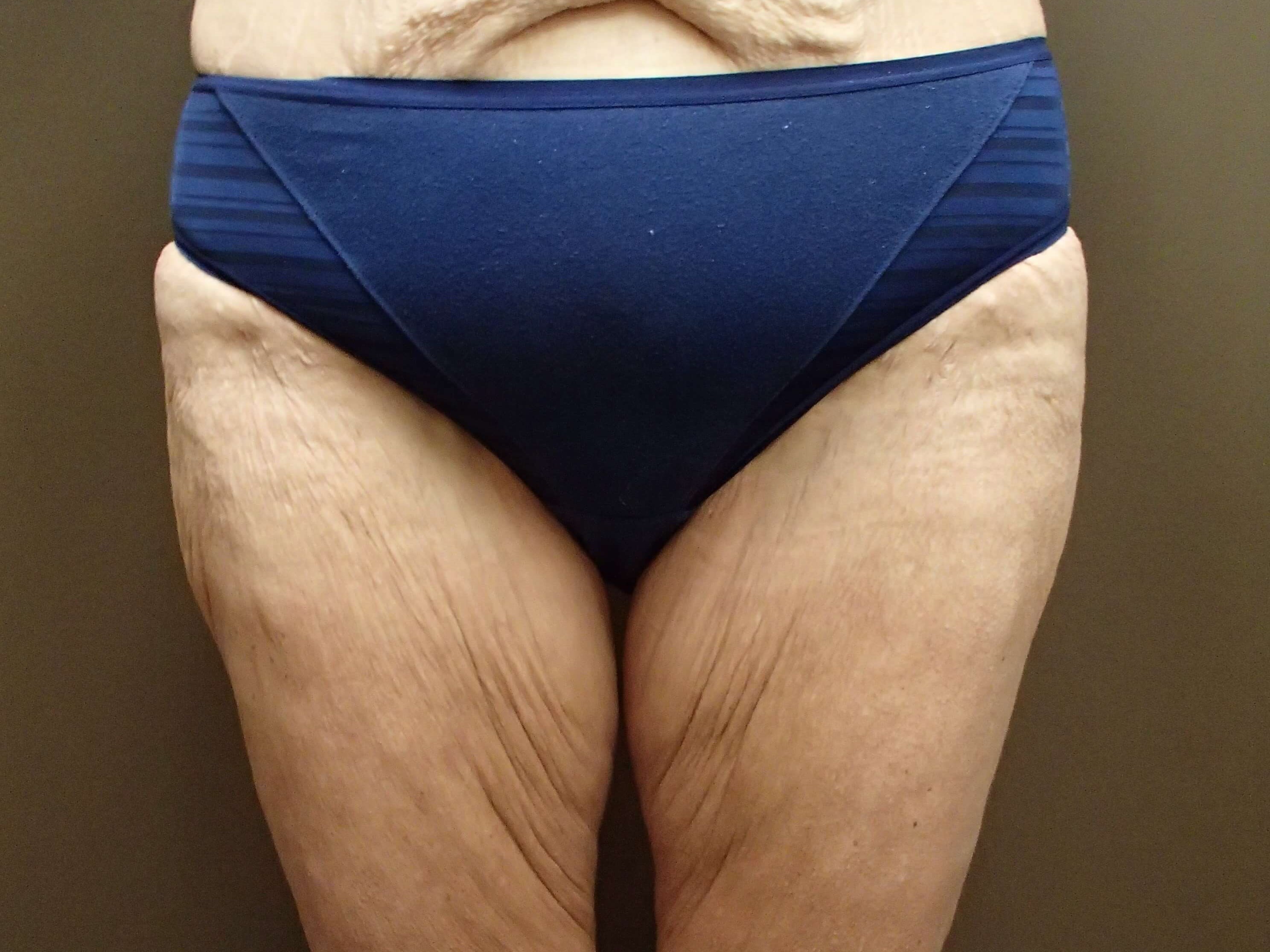 Outer Thigh Liposuction After