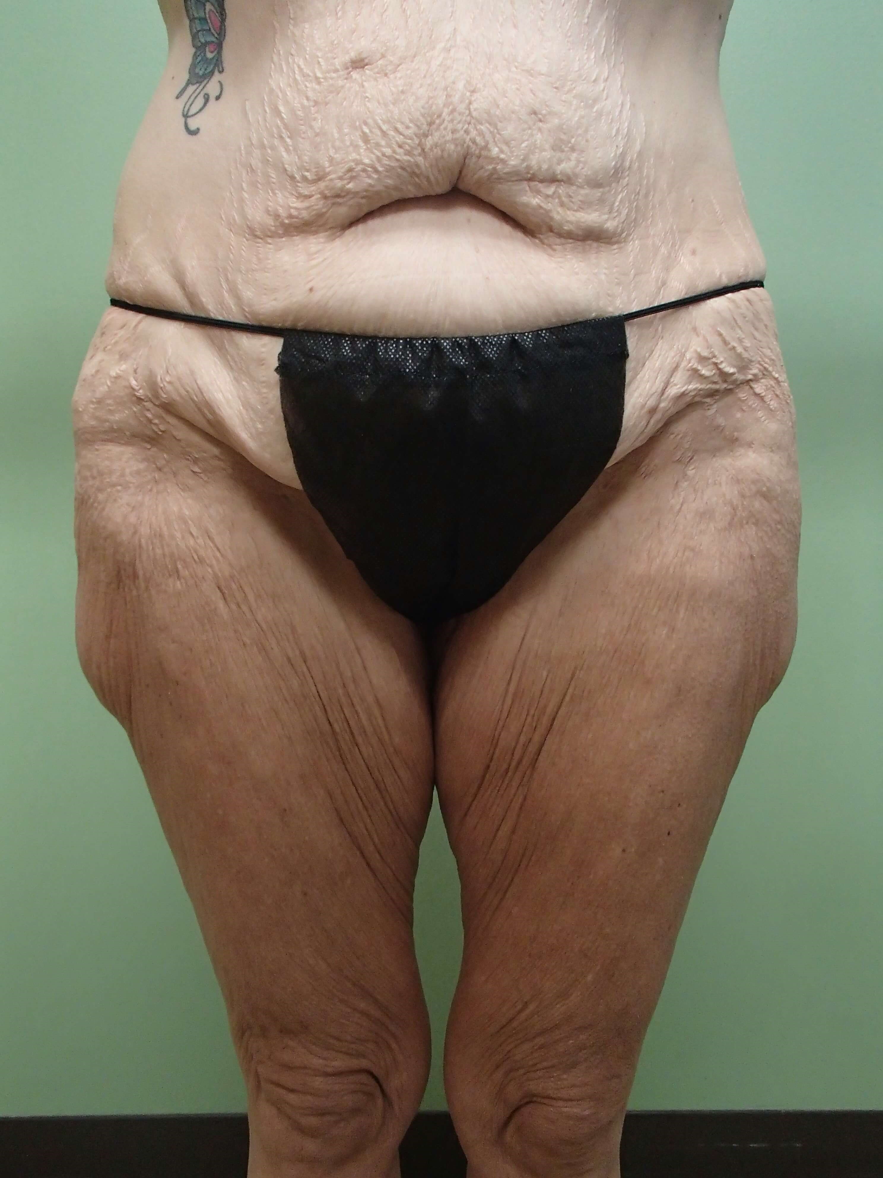 Outer Thigh Liposuction Before