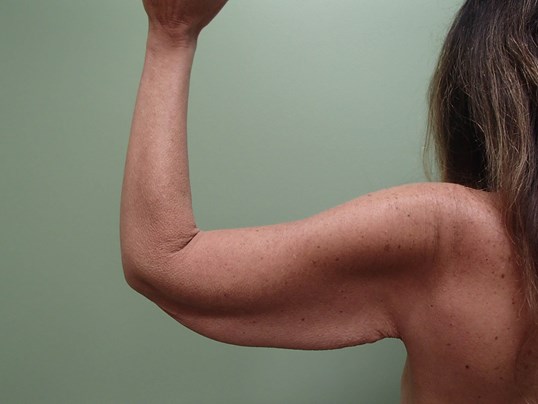 Brachioplasty (Arm Lift) Before