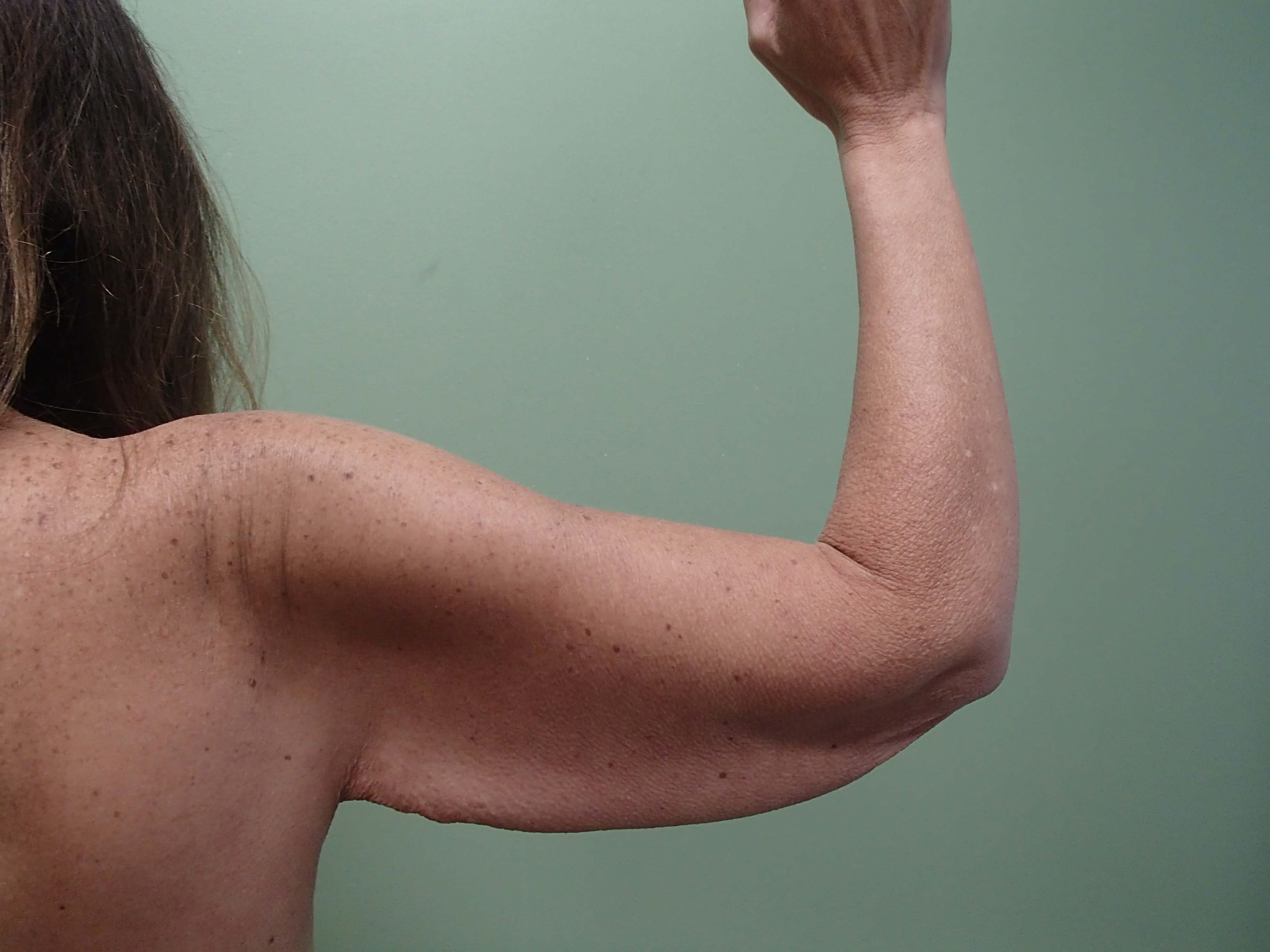 Brachioplasty (Arm Lift) Before