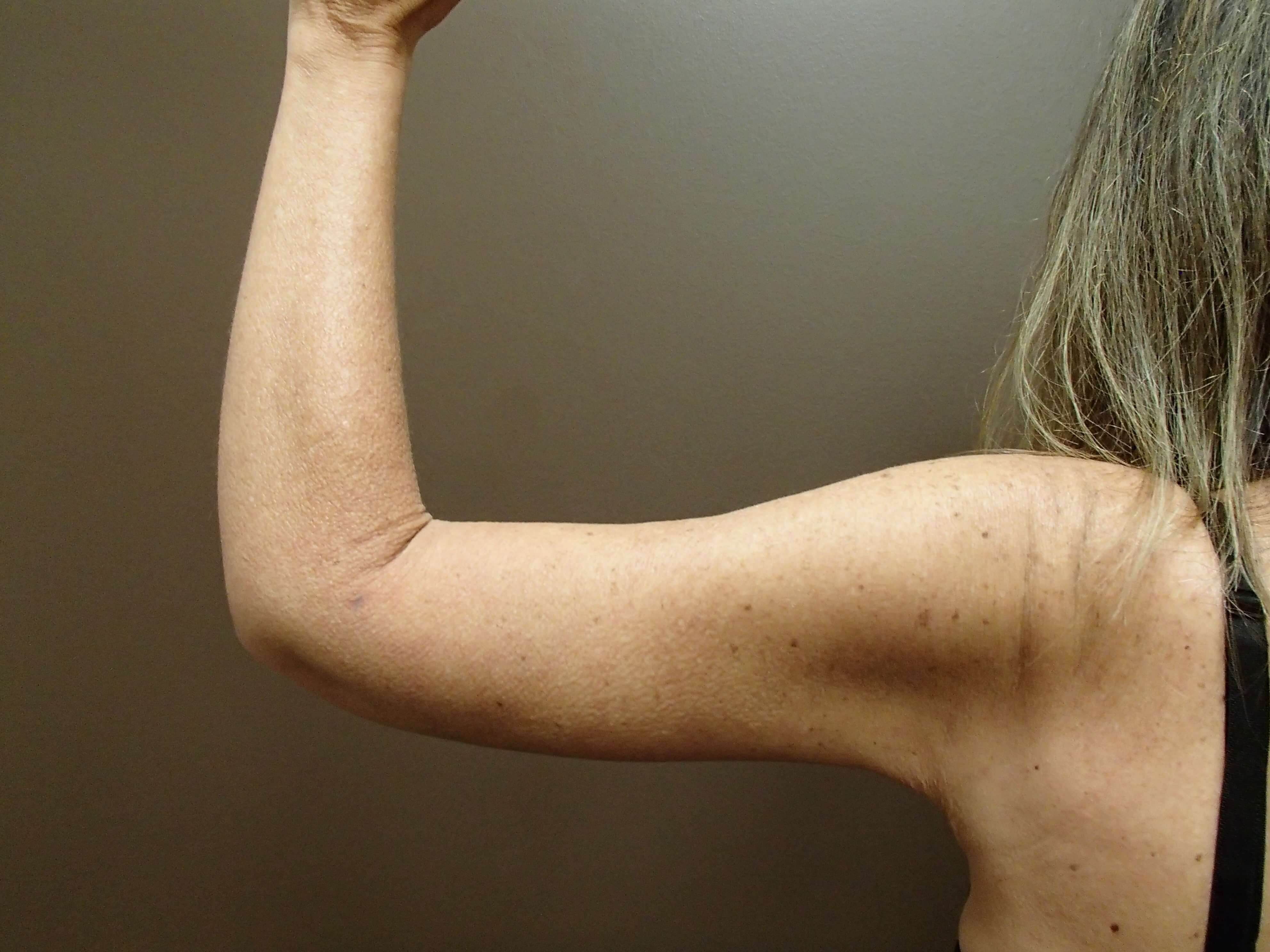 Brachioplasty (Arm Lift) After