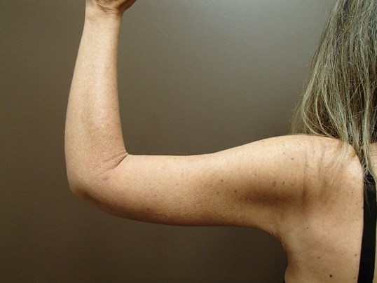 Brachioplasty (Arm Lift) After