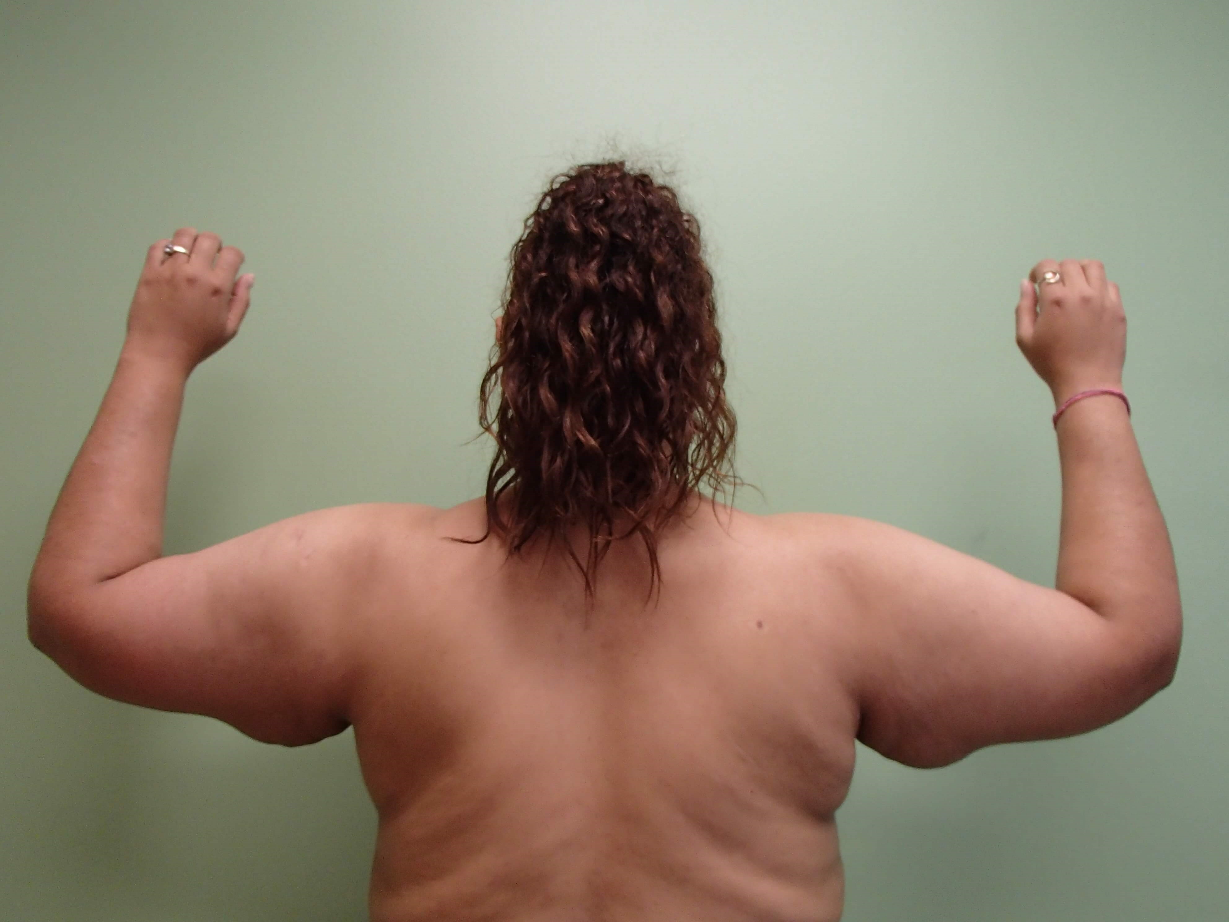 Brachioplasty and Liposuction Before