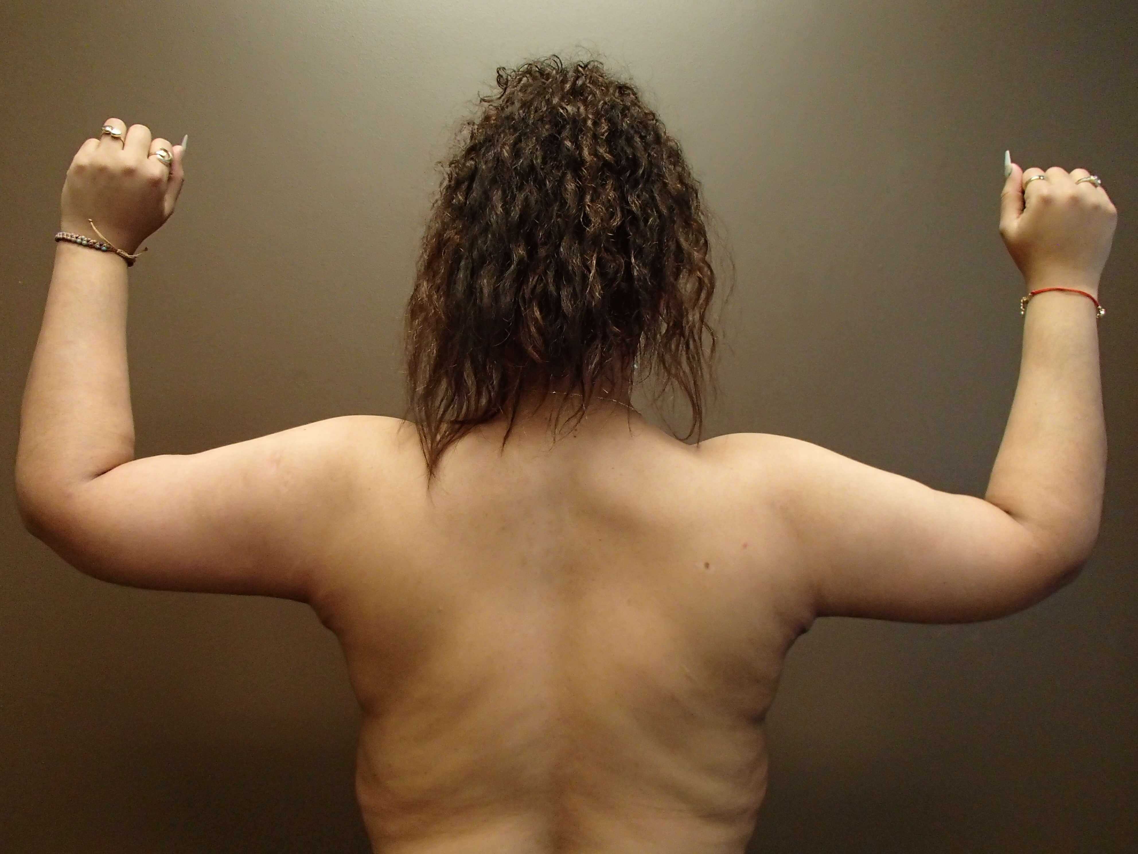 Brachioplasty and Liposuction After