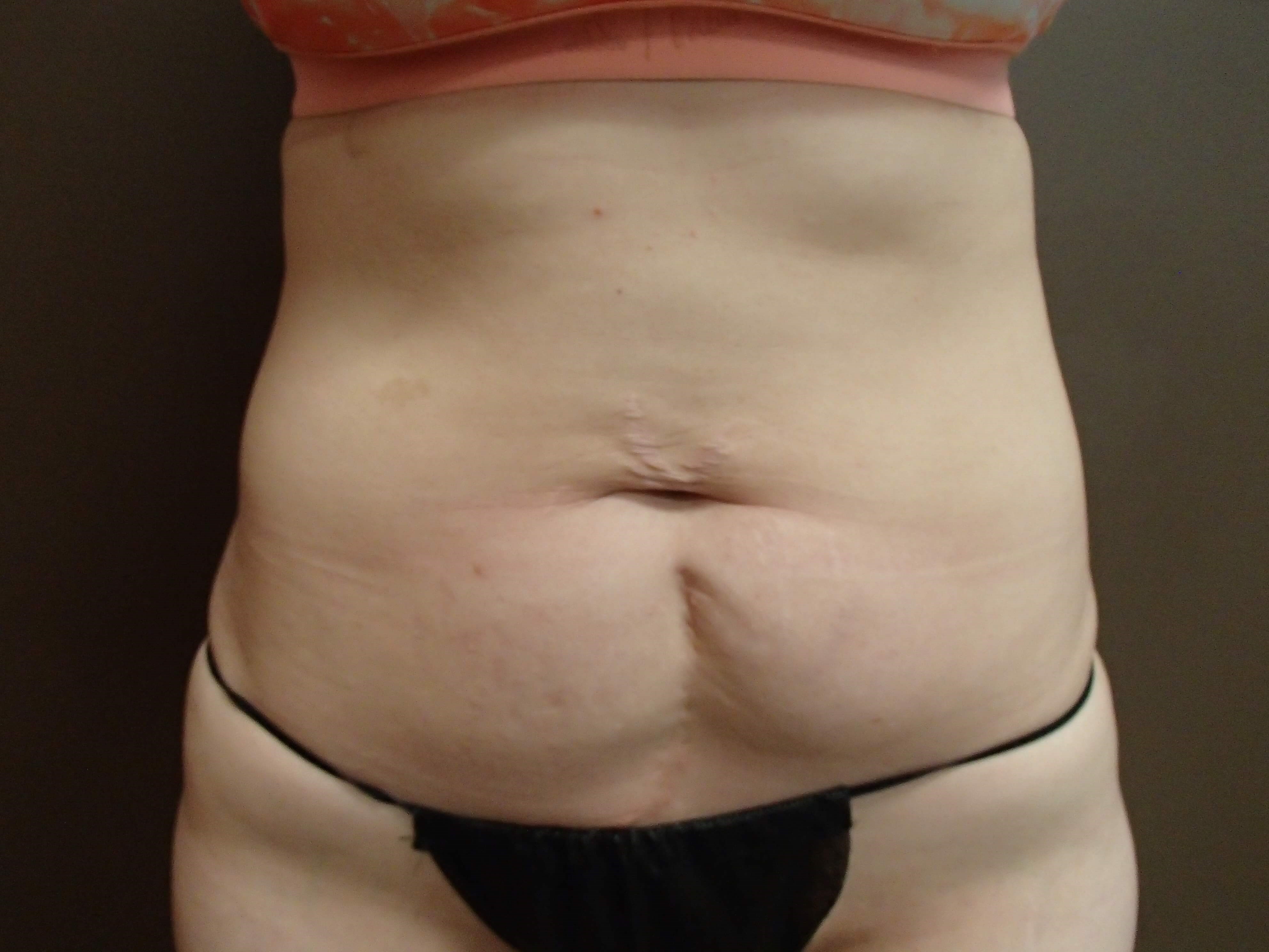 Abdominoplasty and Liposuction Before
