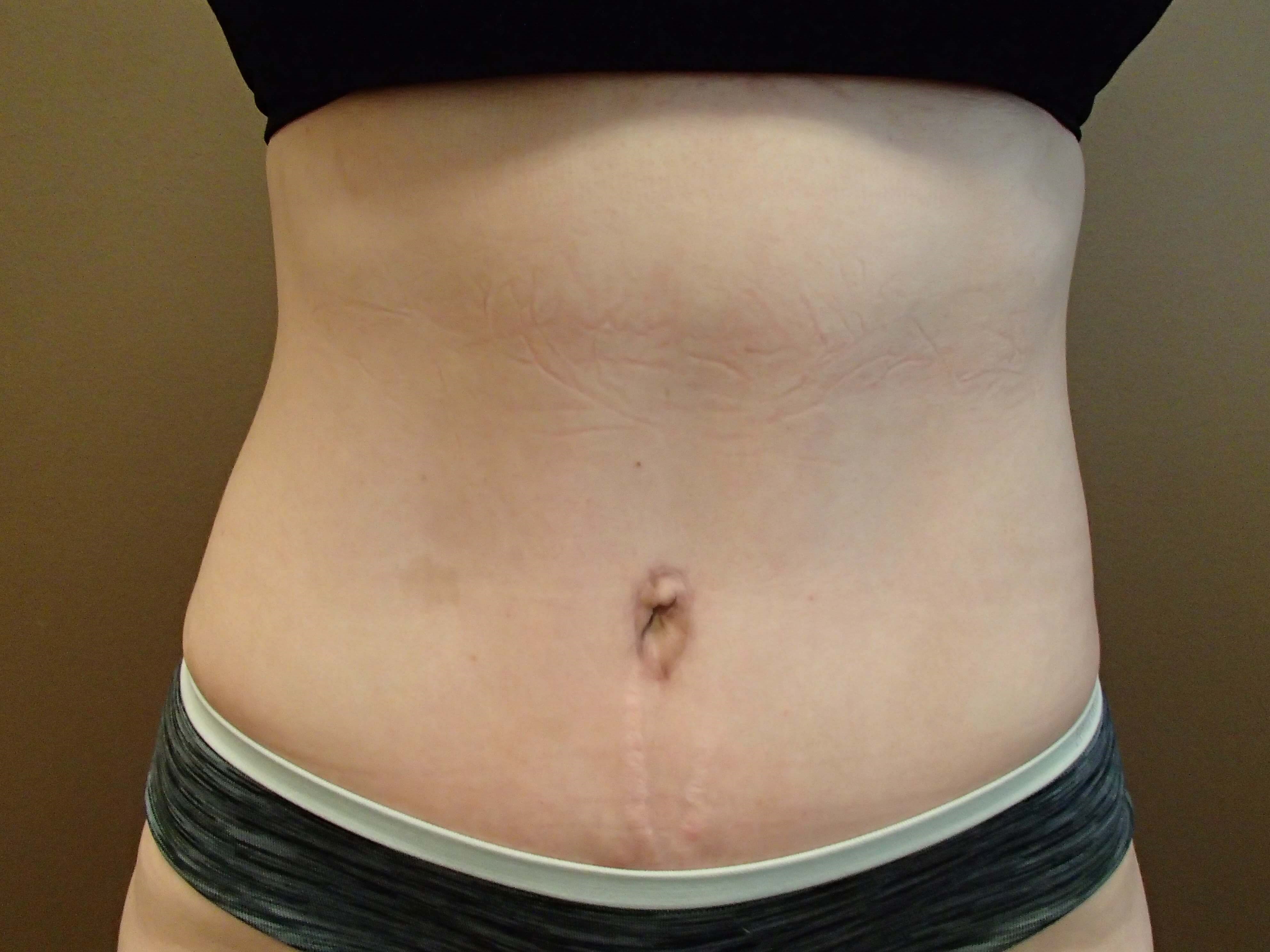 Abdominoplasty and Liposuction After
