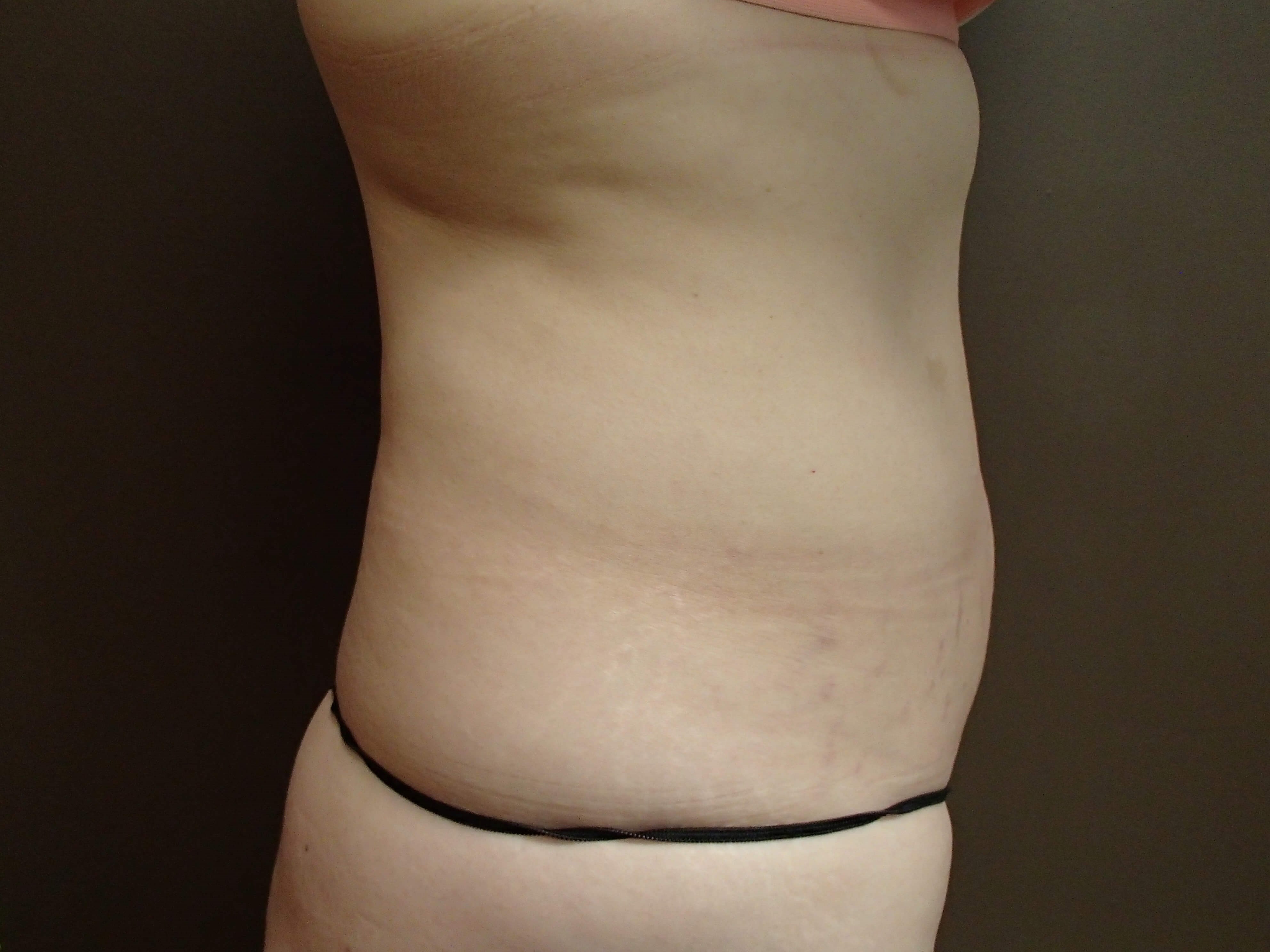Abdominoplasty and Liposuction Before