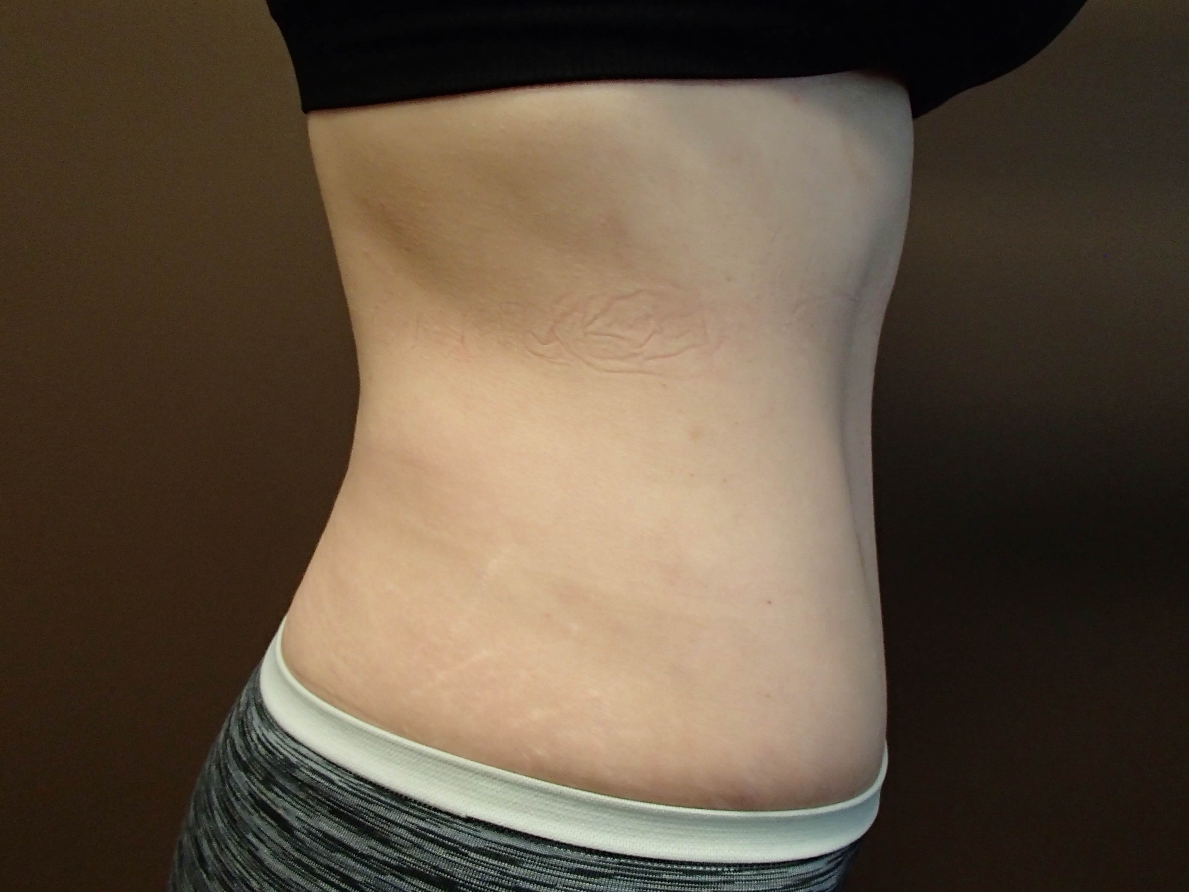 Abdominoplasty and Liposuction After