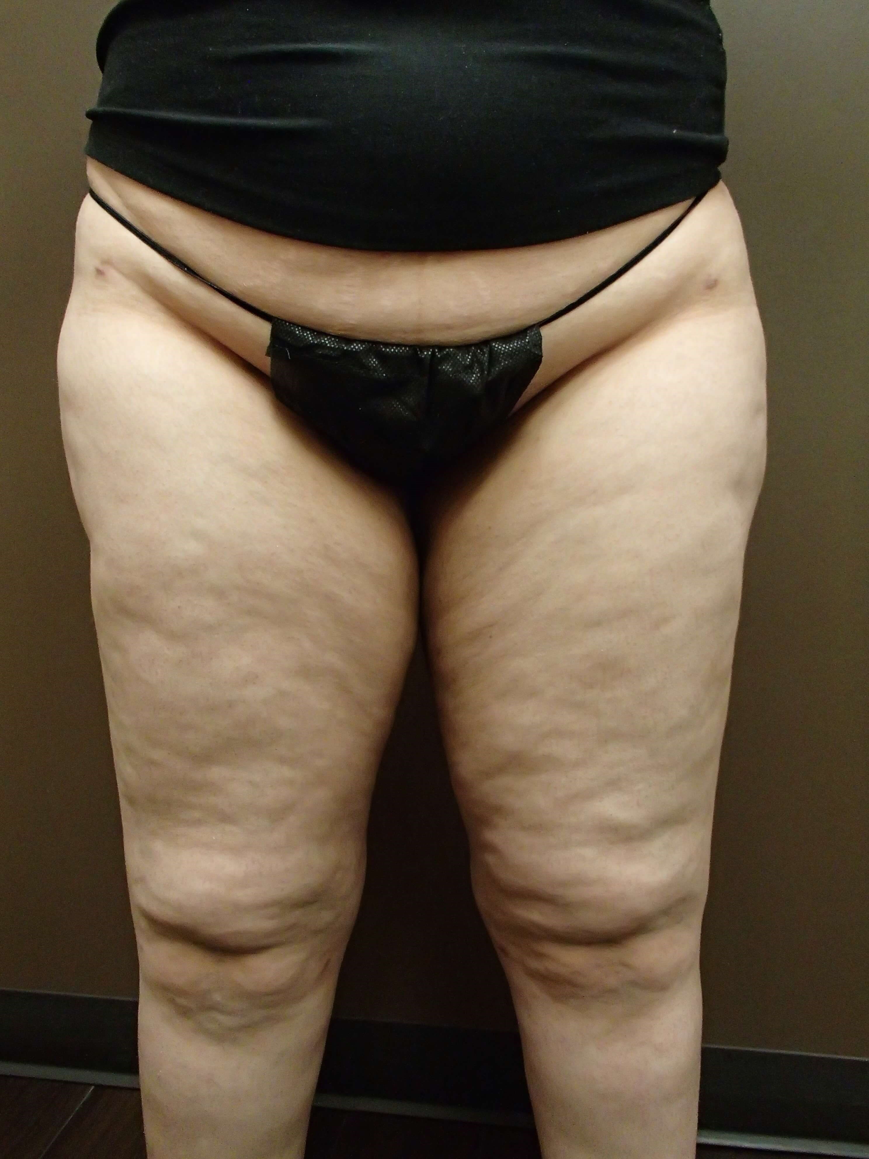 Liposuction to Thighs After