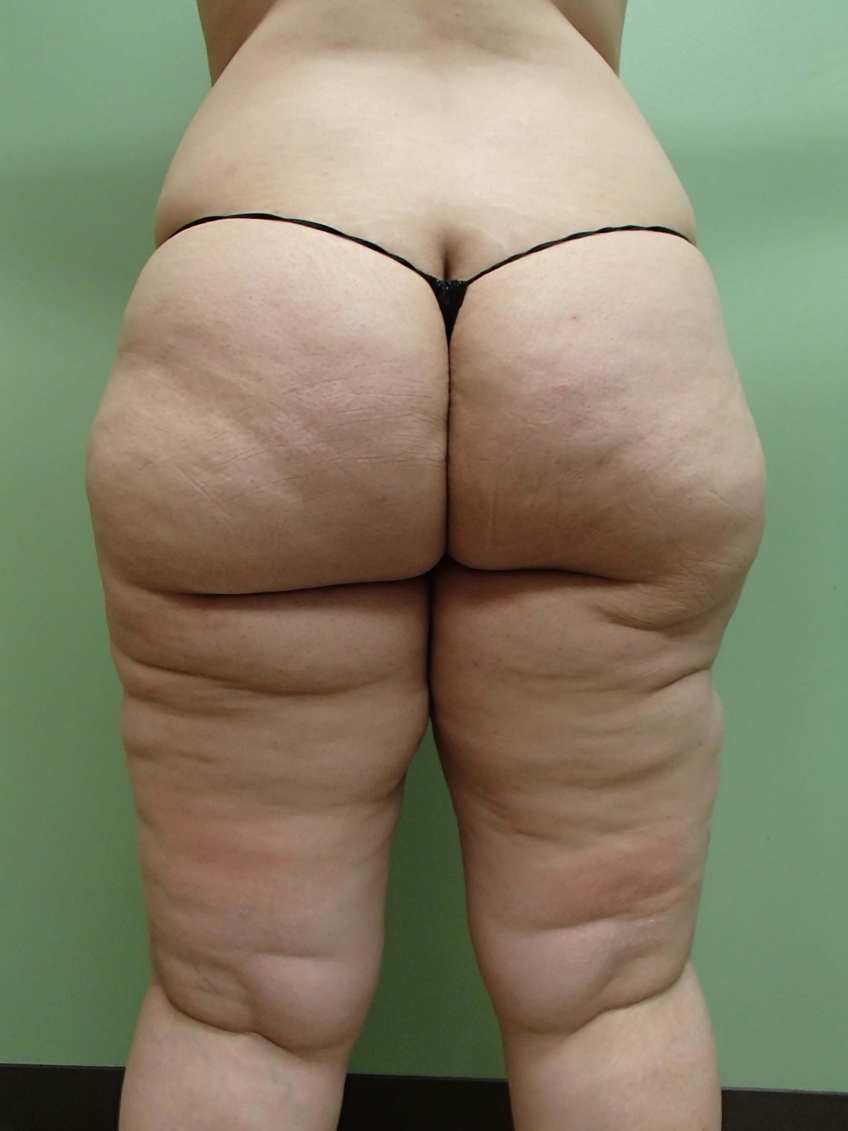 Liposuction to Thighs Before