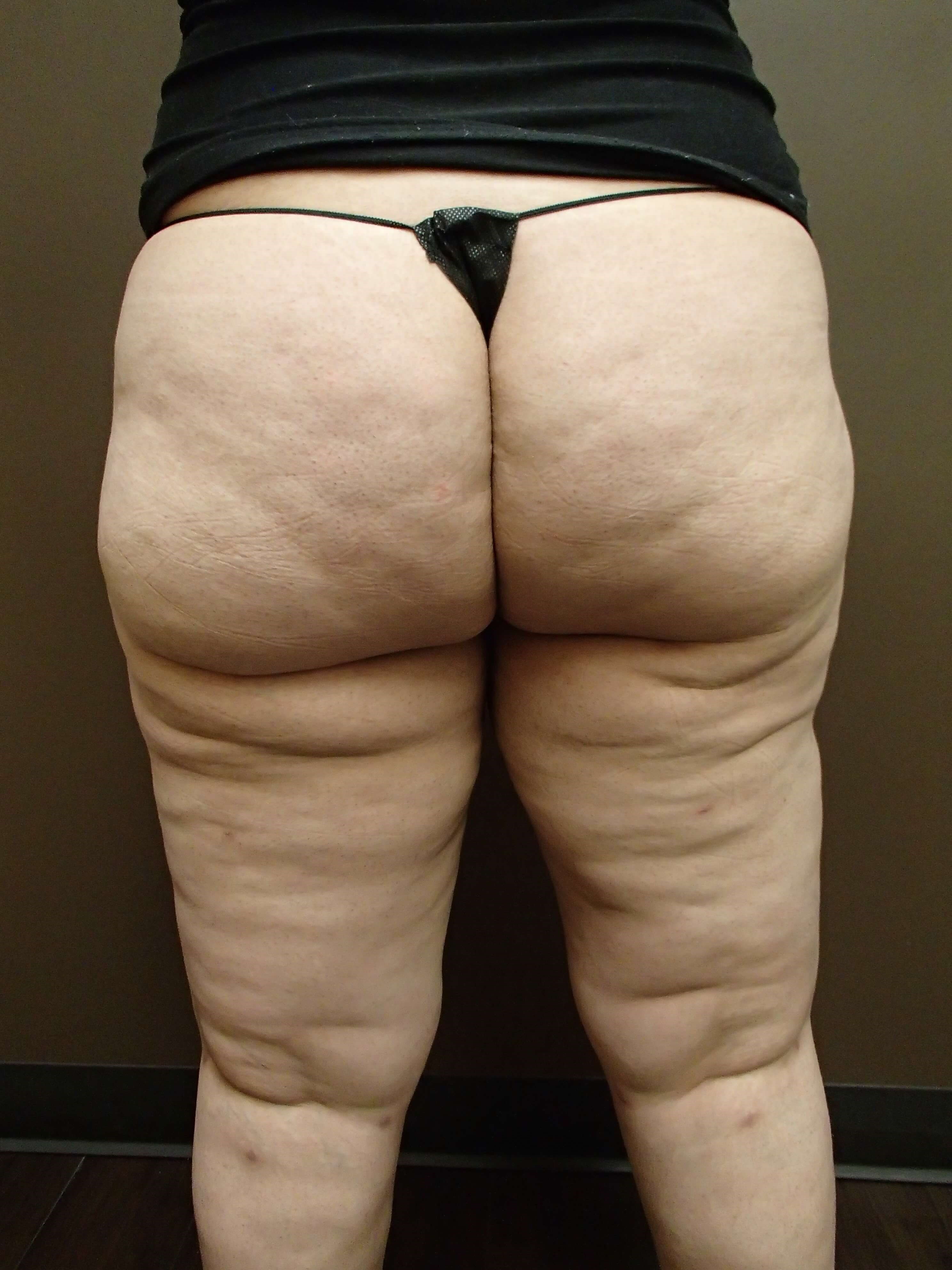Liposuction to Thighs After