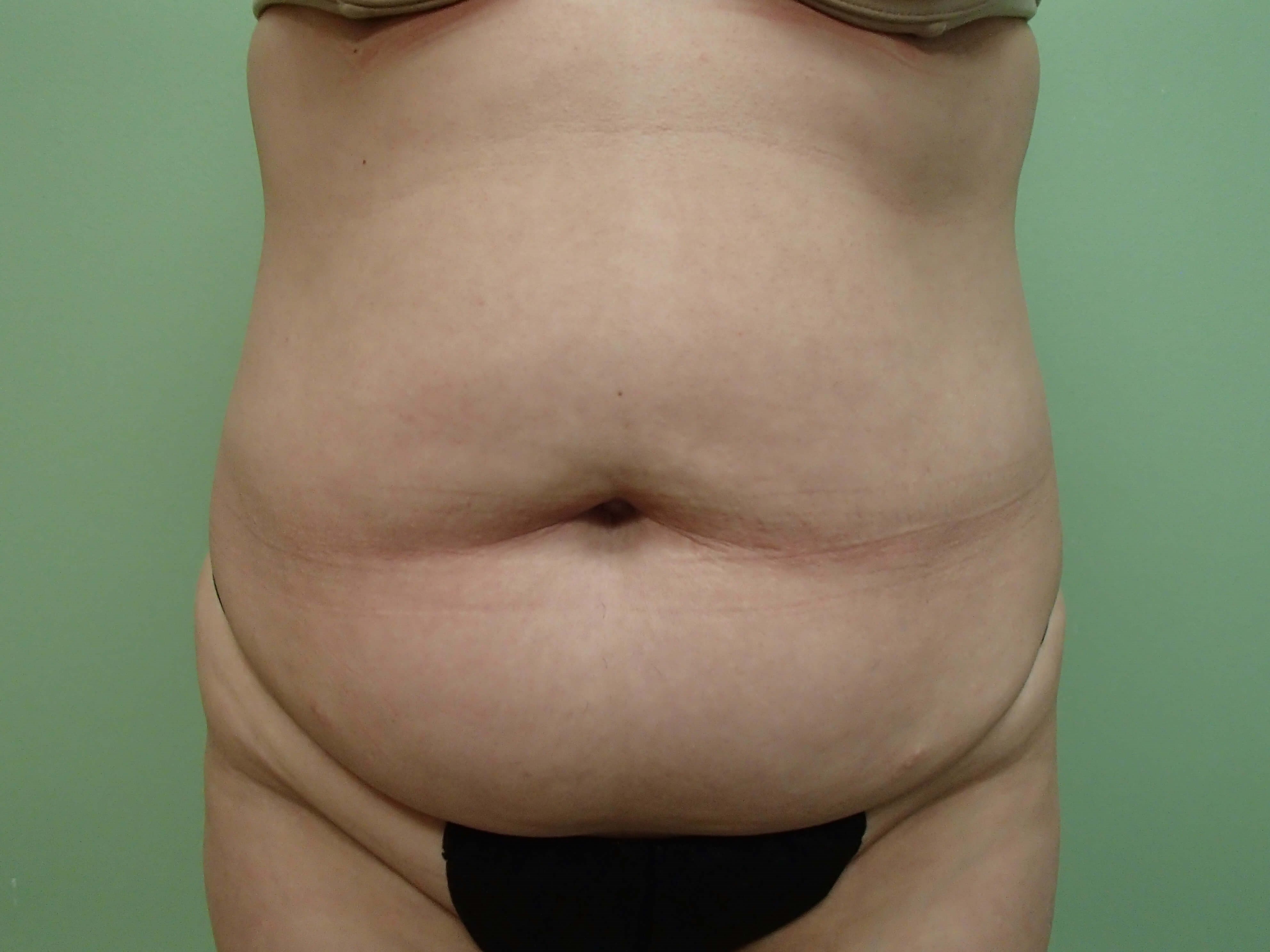 Abdominoplasty and Liposuction Before