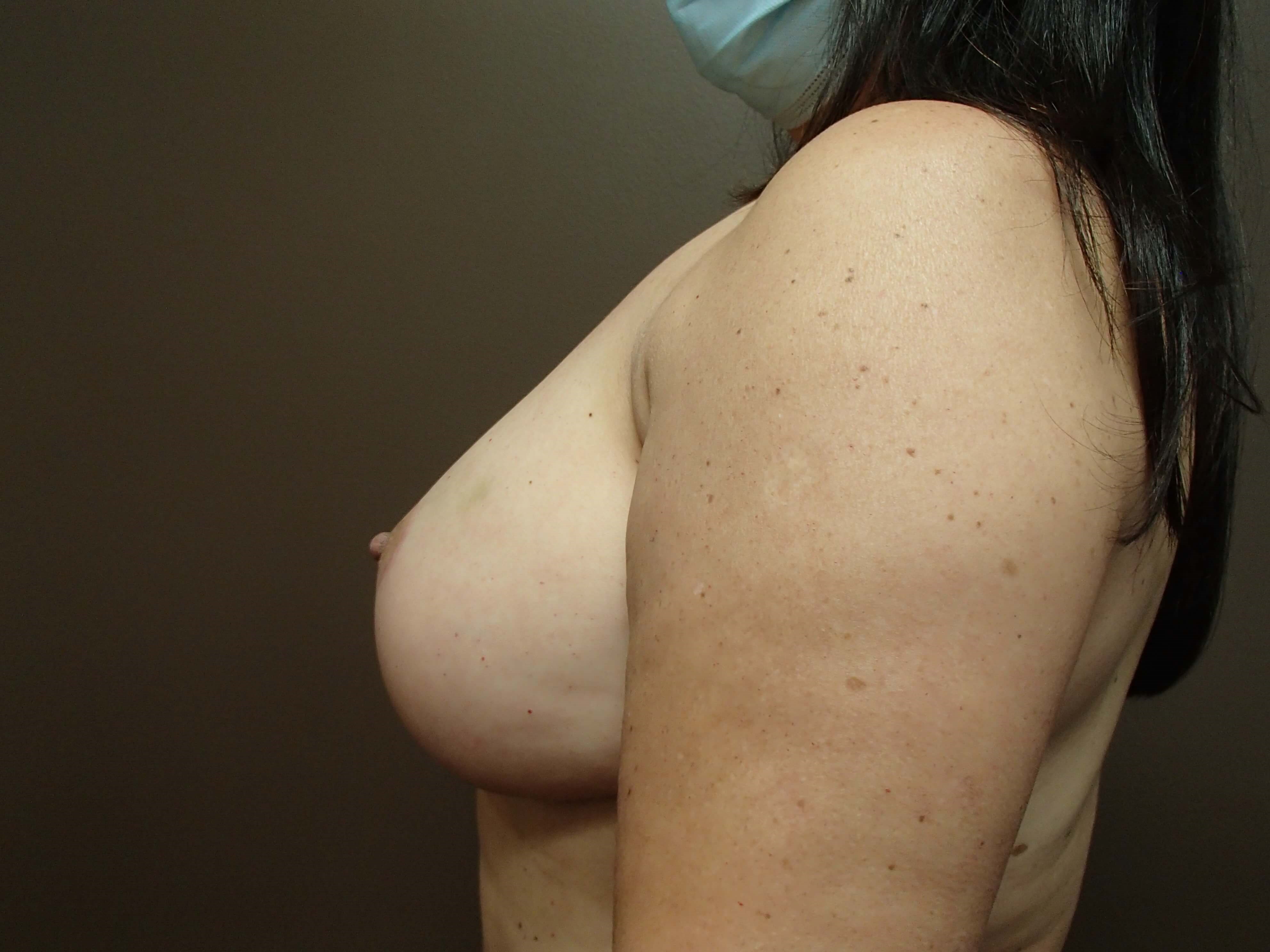 Mastopexy with Breast Aug After