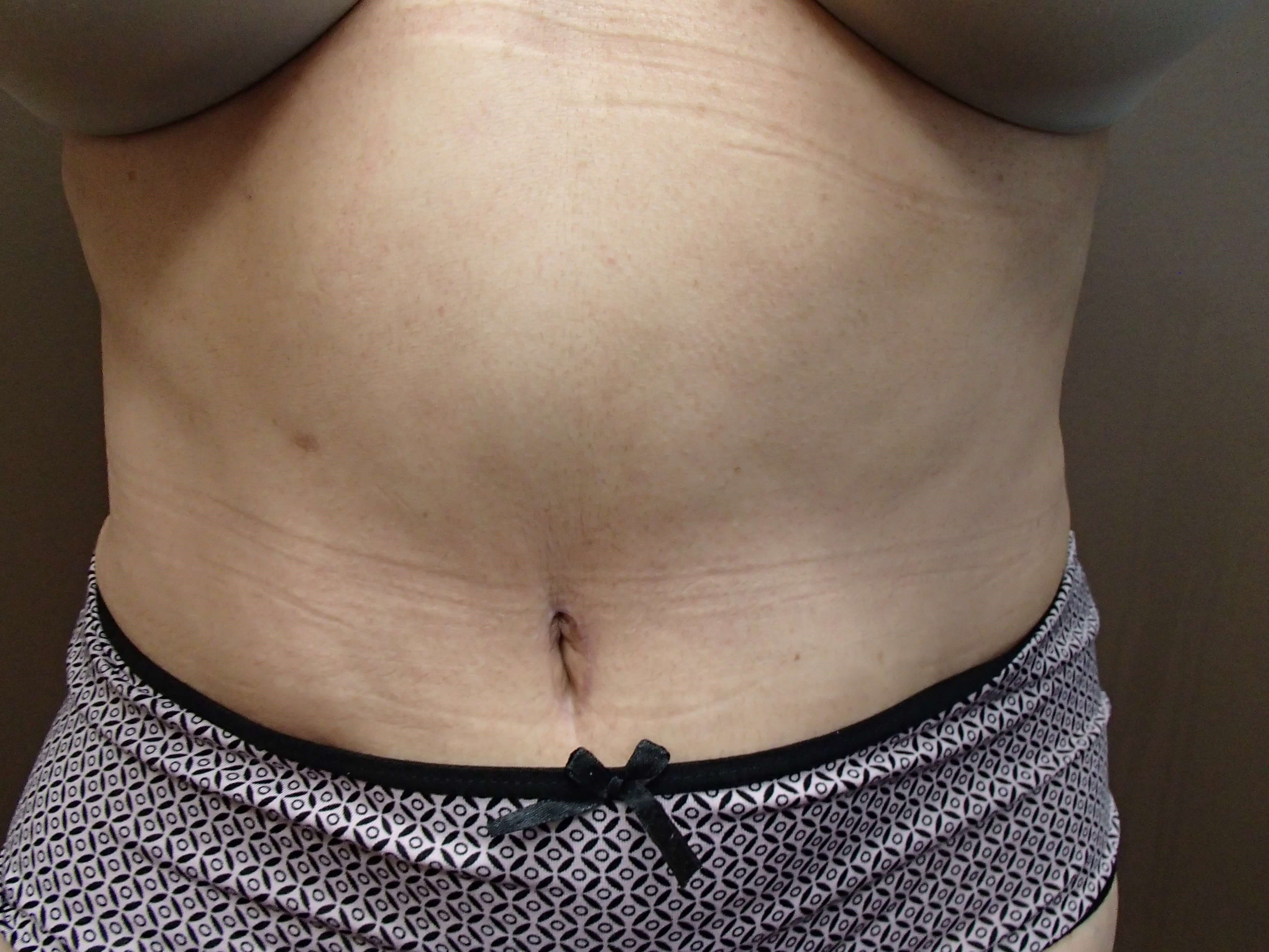 Abdominoplasty and Liposuction After