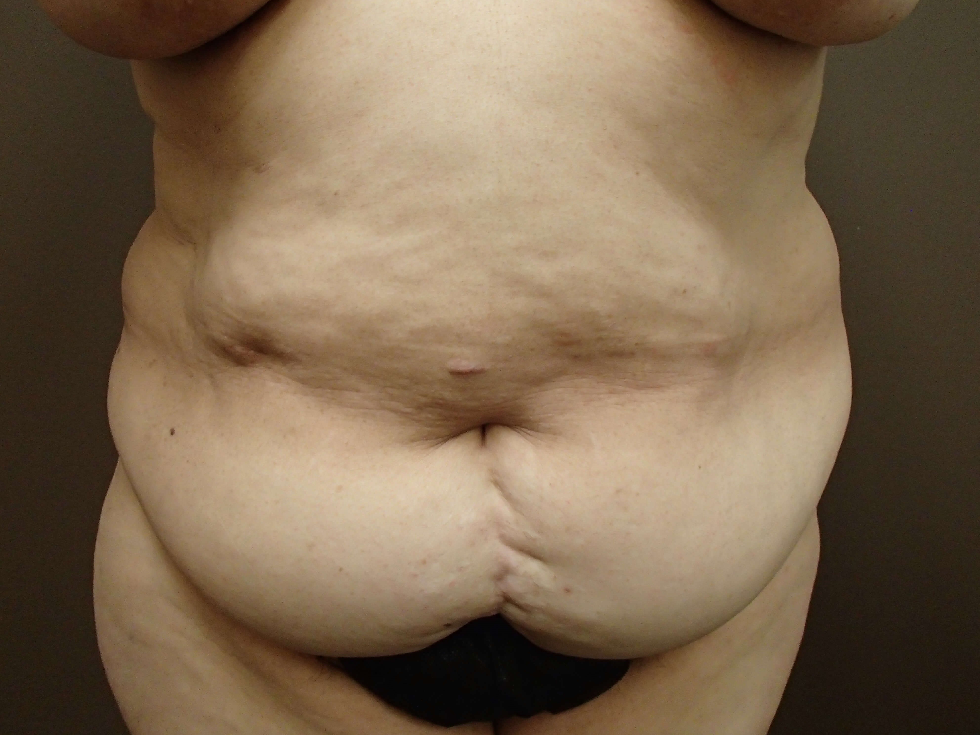 Abdominoplasty and Liposuction Before