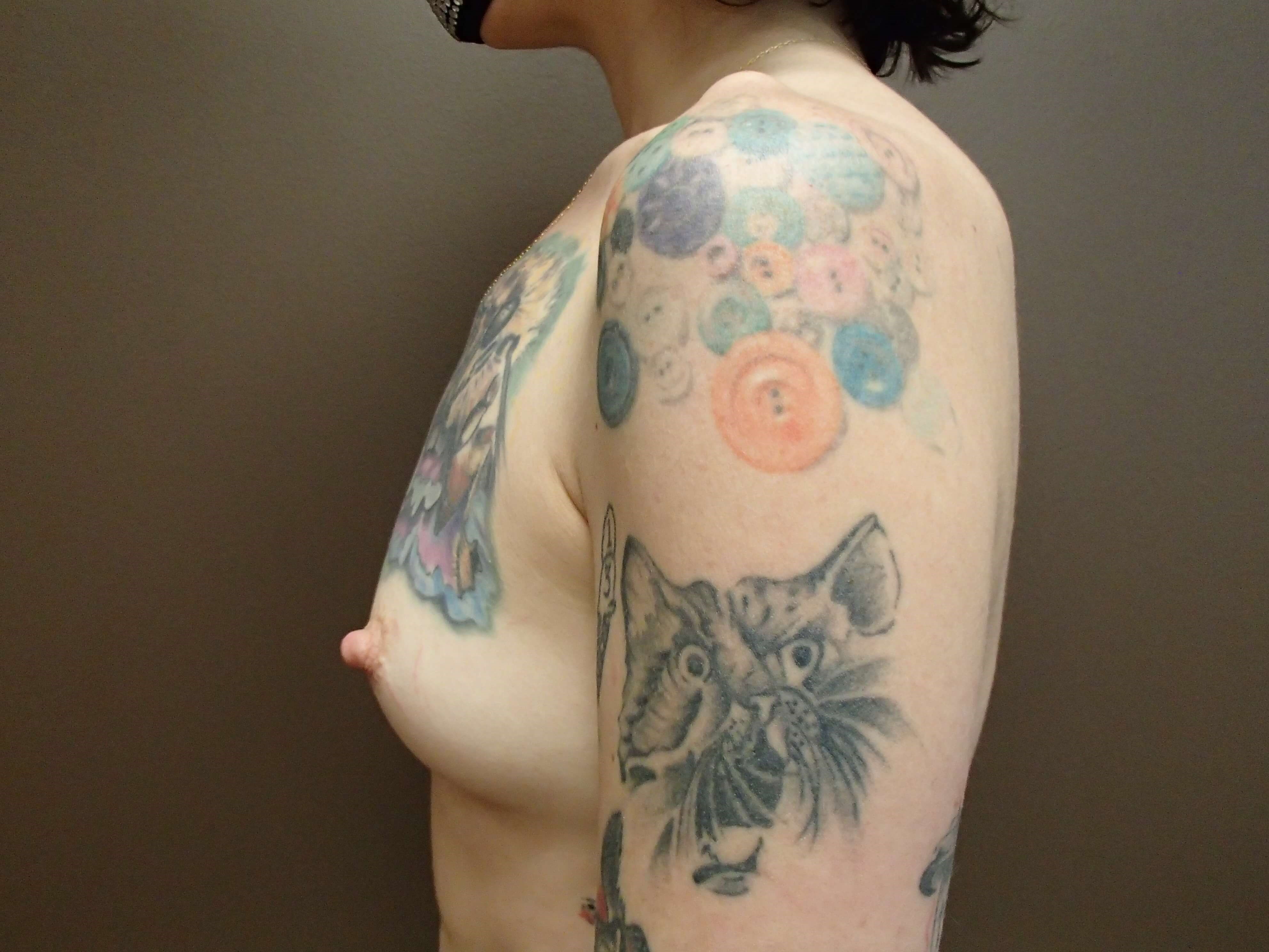 Breast Augmentation Before