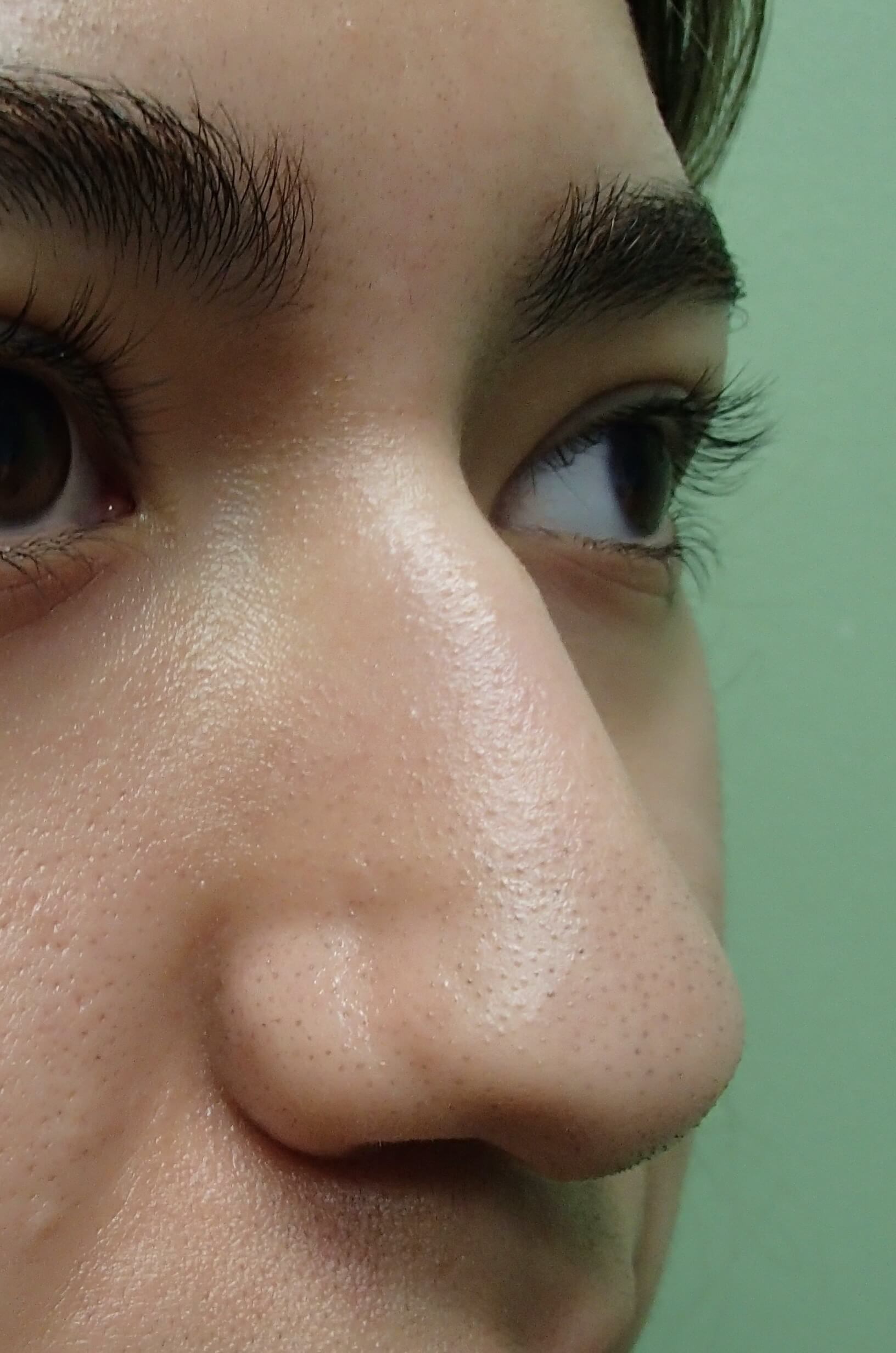 Rhinoplasty Before