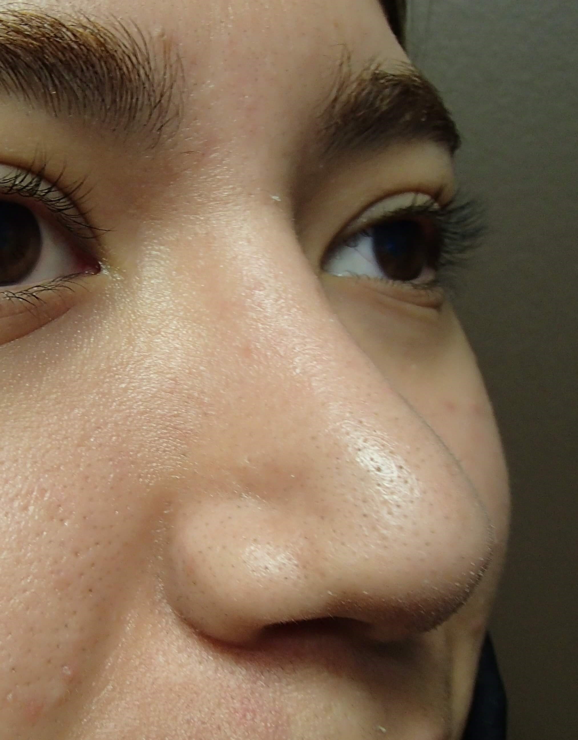 Rhinoplasty After