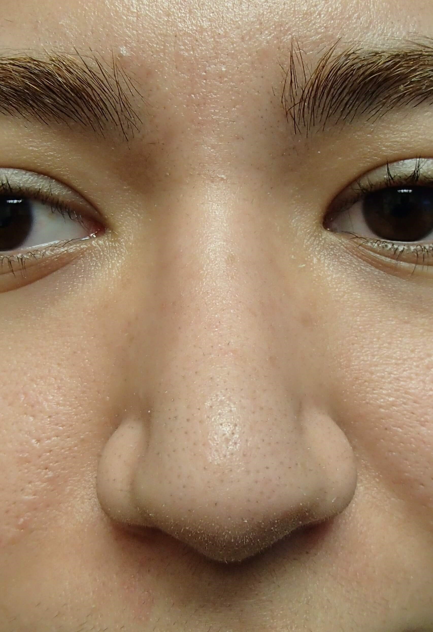 Rhinoplasty After