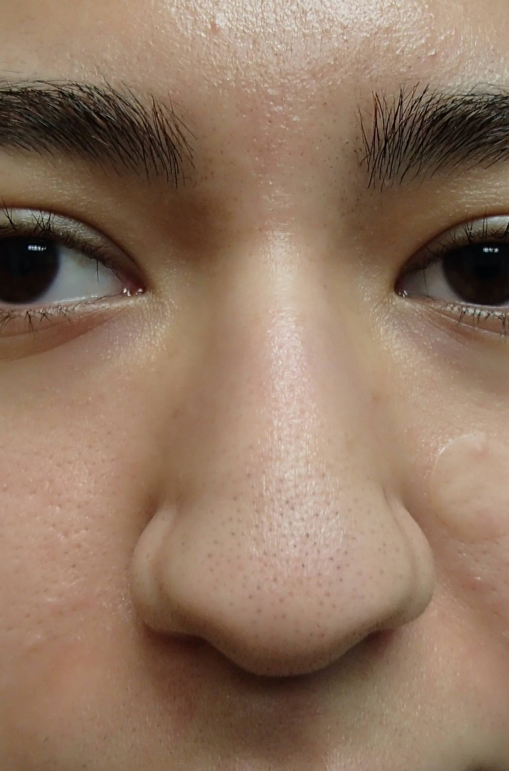 Rhinoplasty Before
