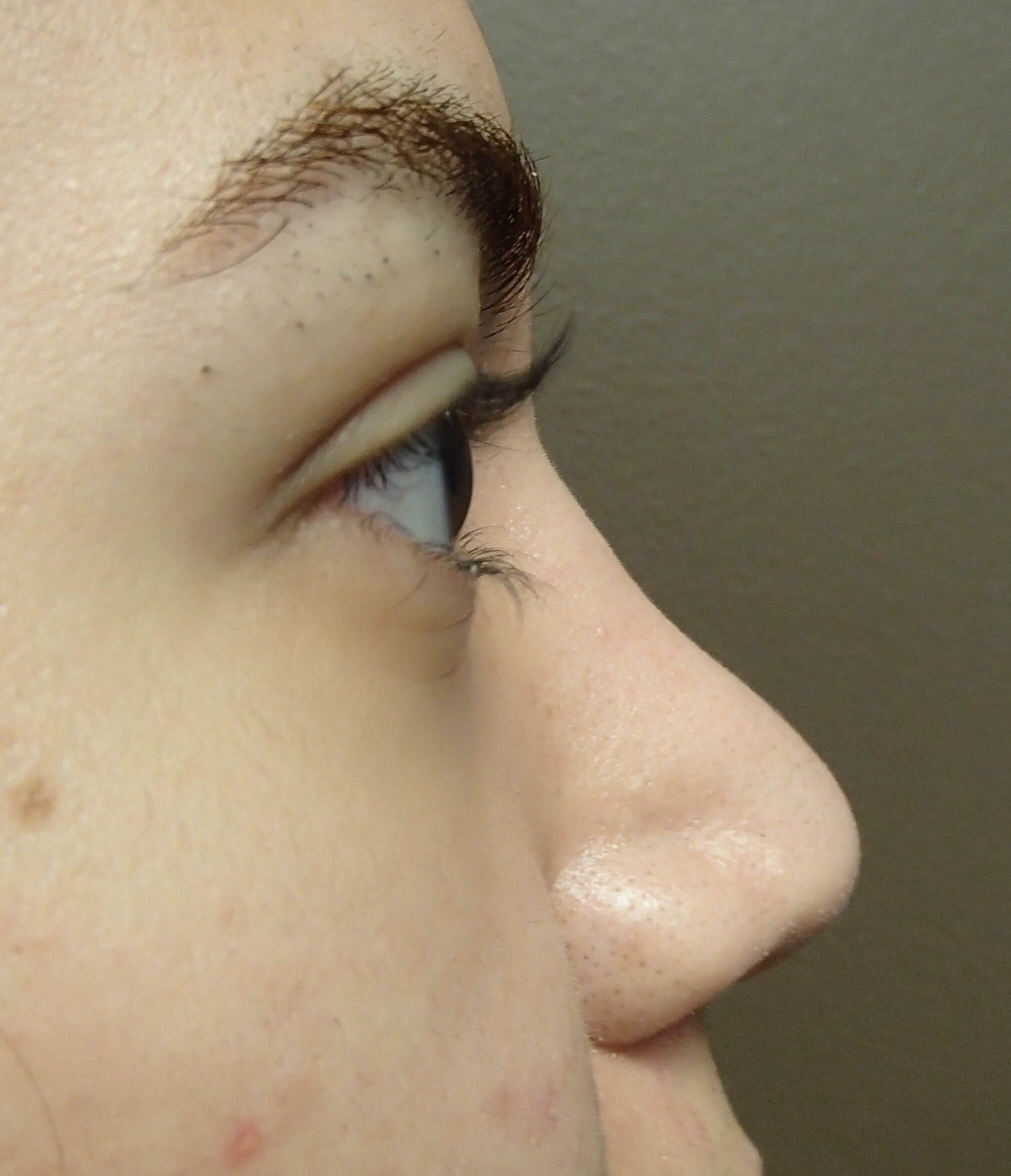 Rhinoplasty After