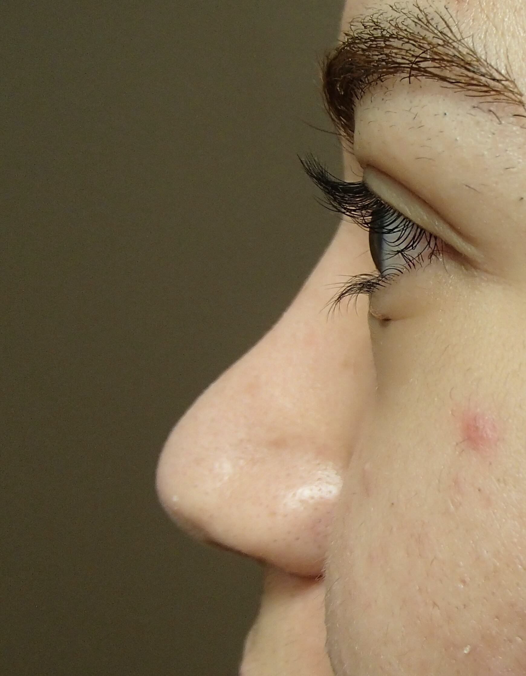 Rhinoplasty After