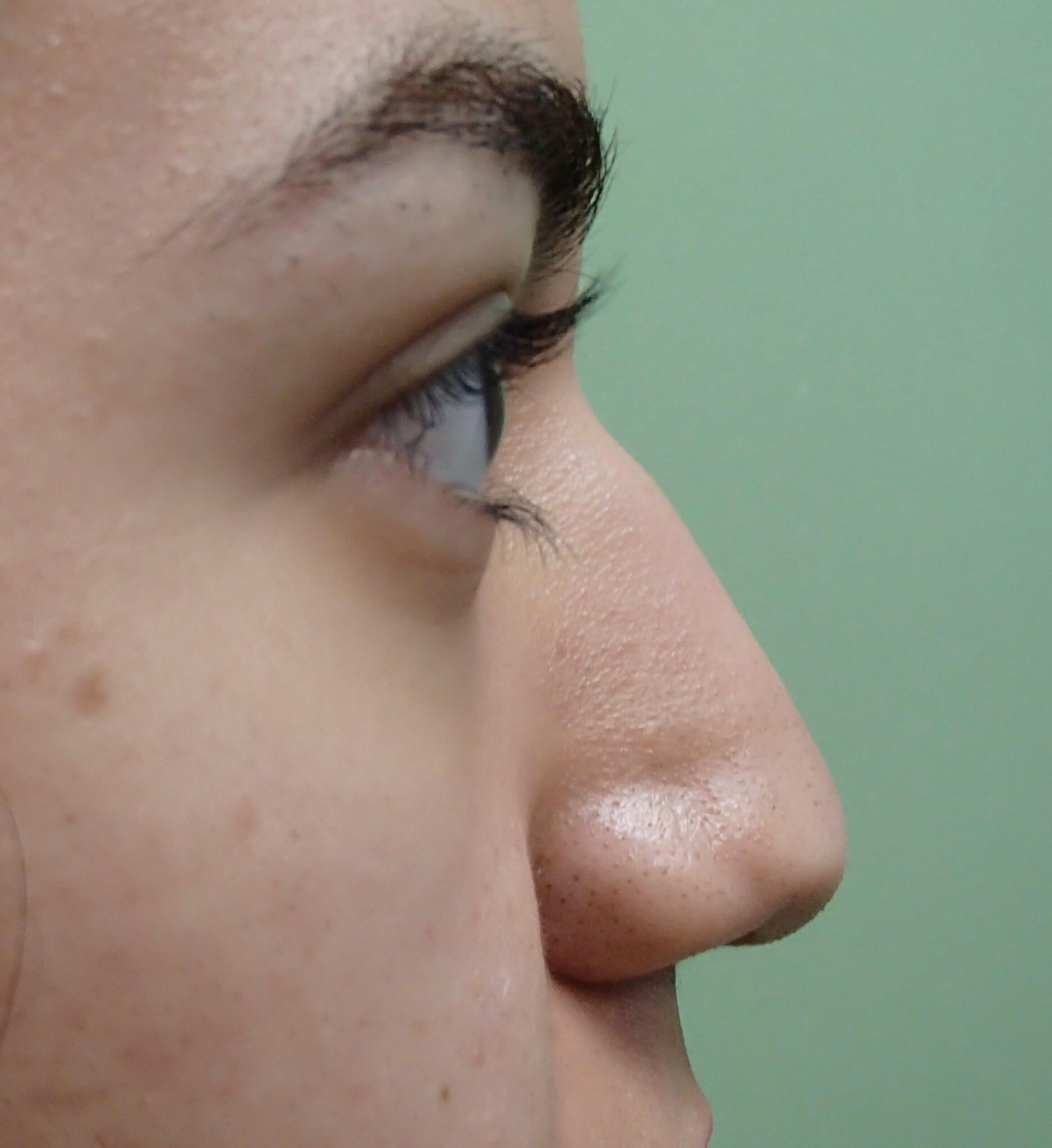 Rhinoplasty Before