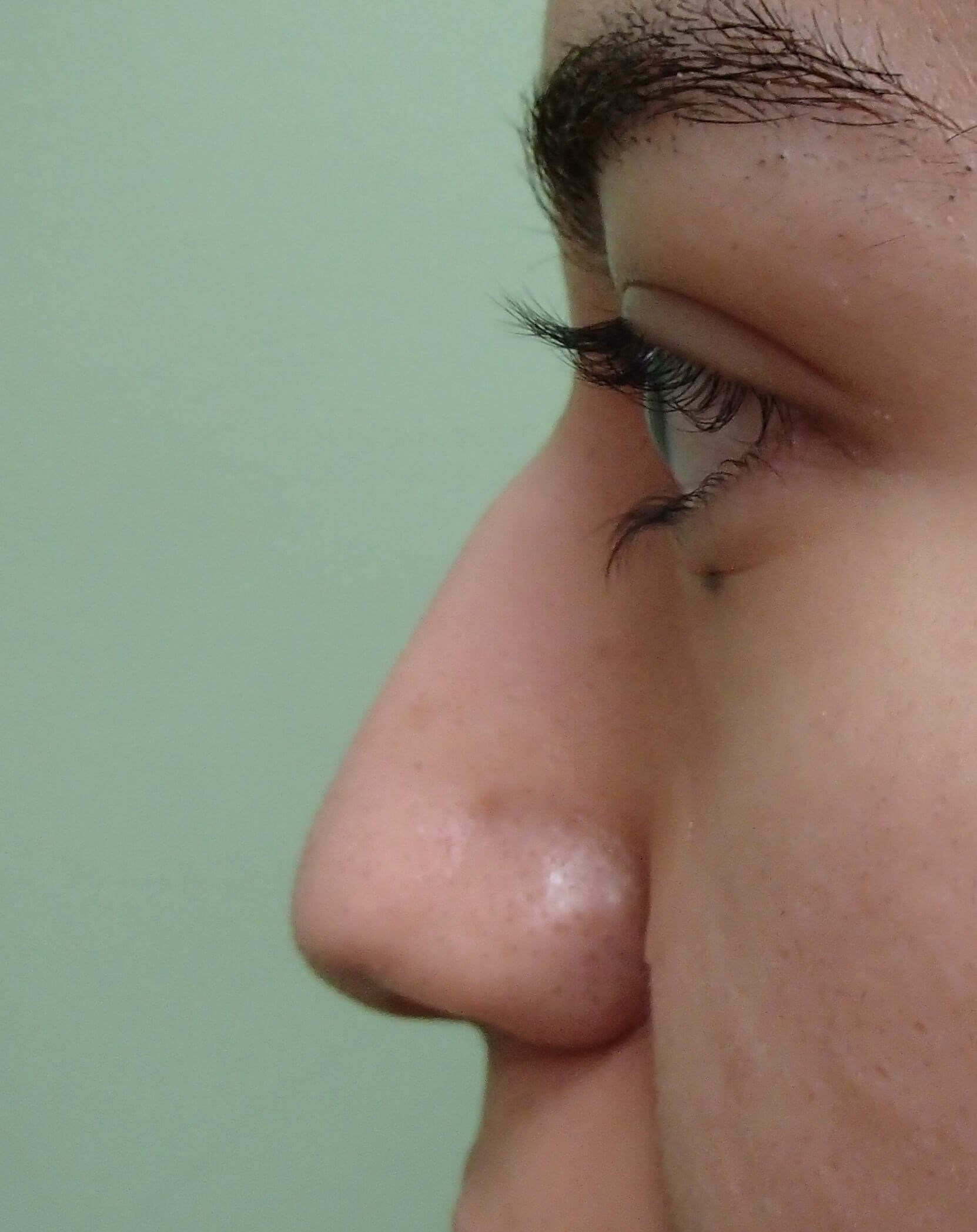 Rhinoplasty Before