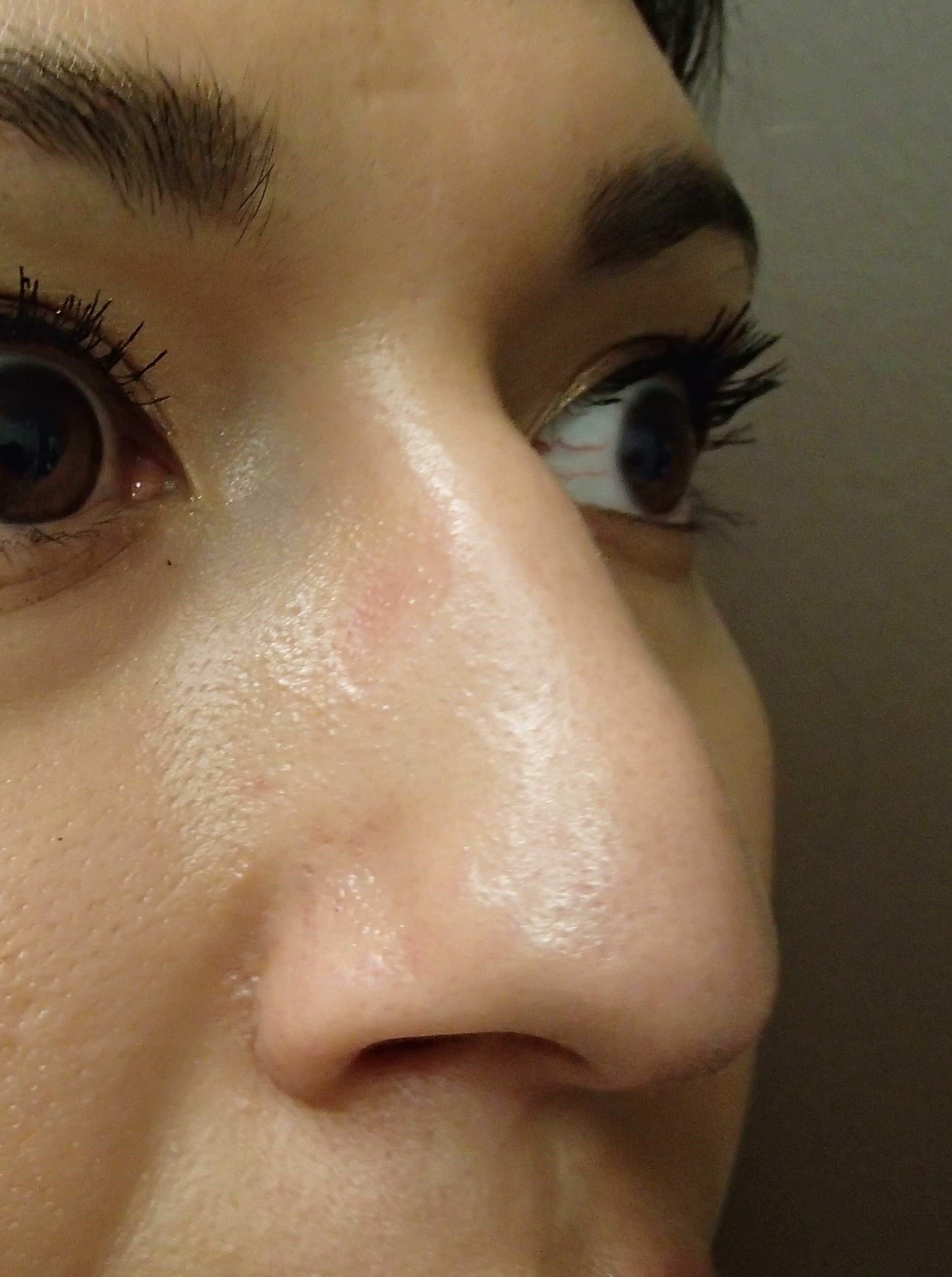 Rhinoplasty Before