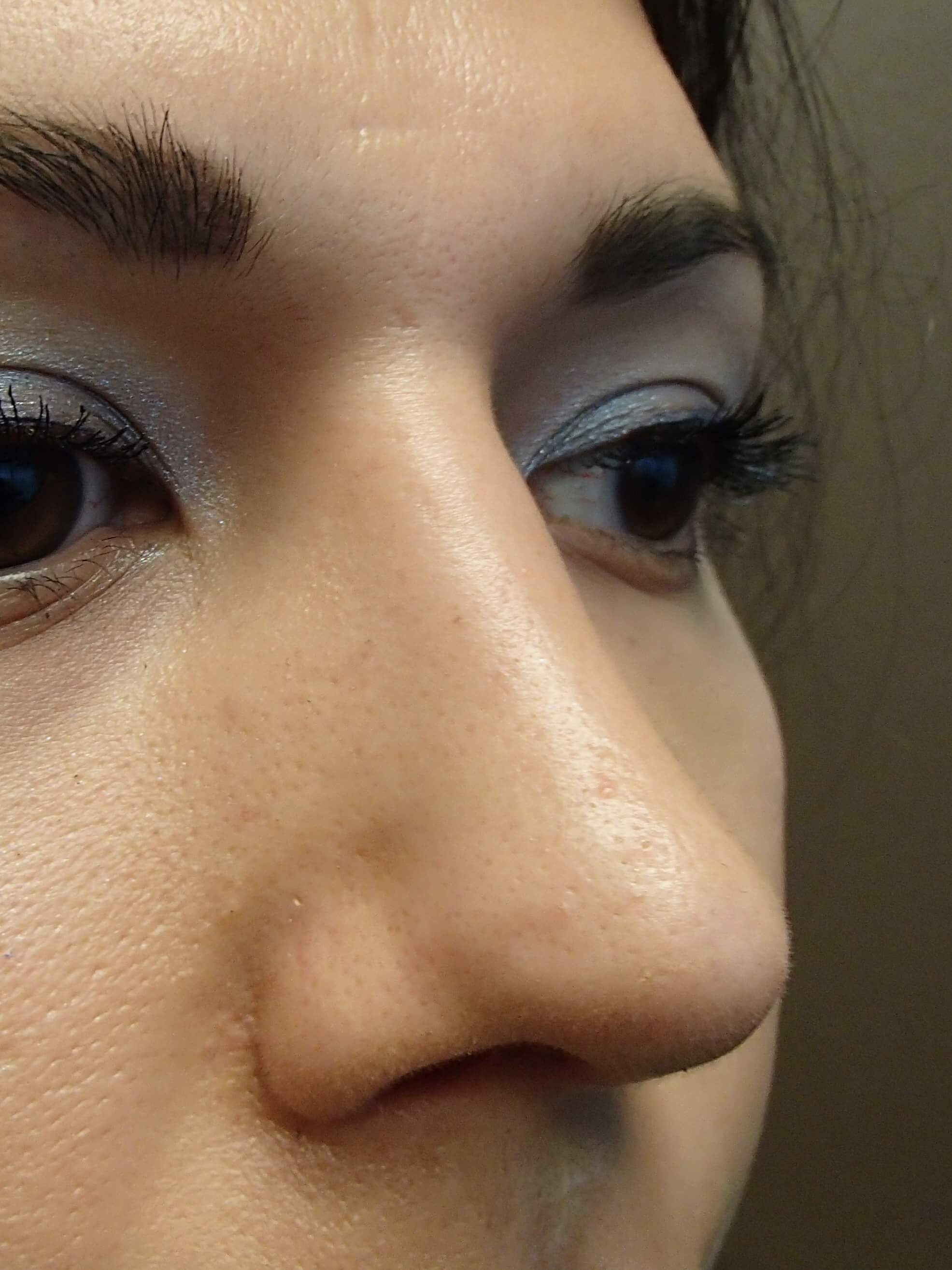 Rhinoplasty After