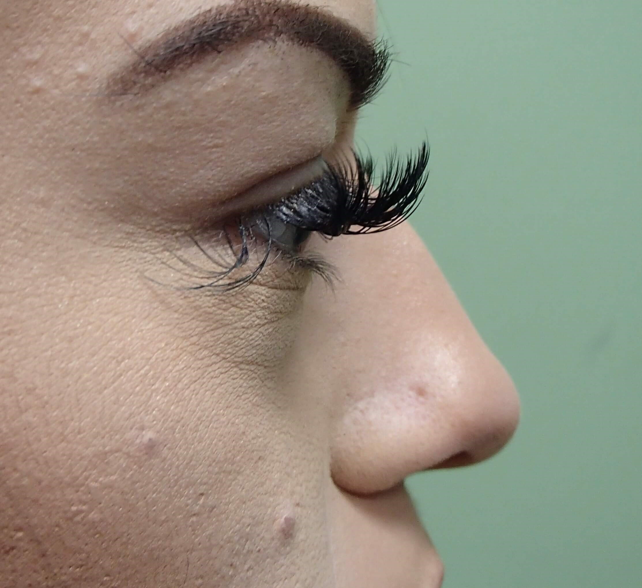 Rhinoplasty Before
