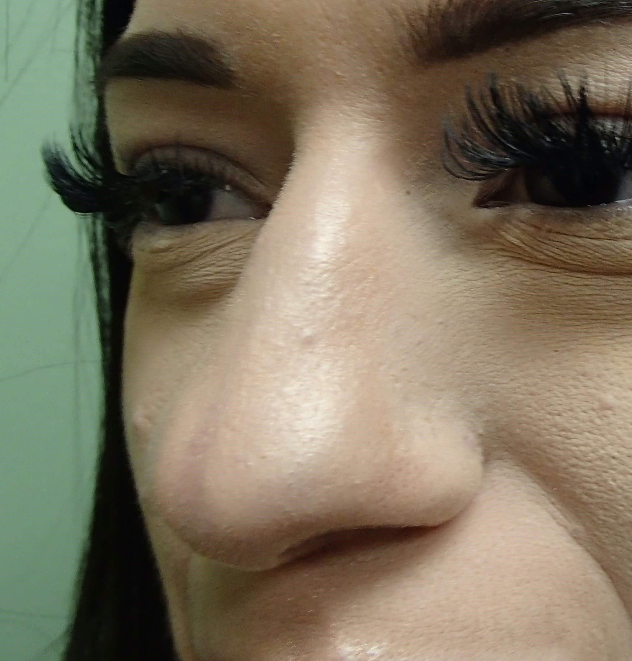 Rhinoplasty Before