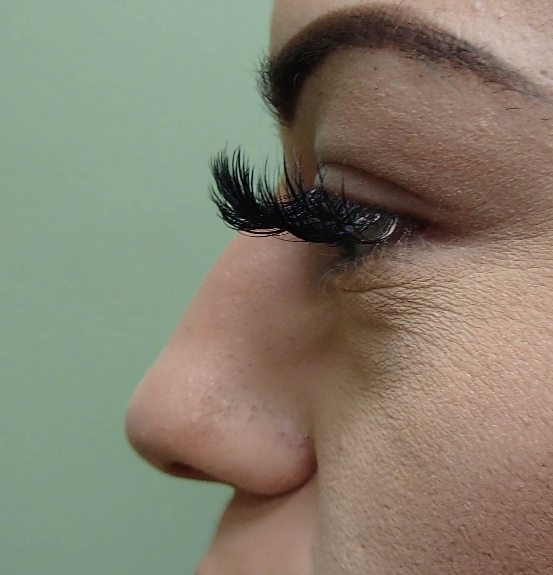 Rhinoplasty Before