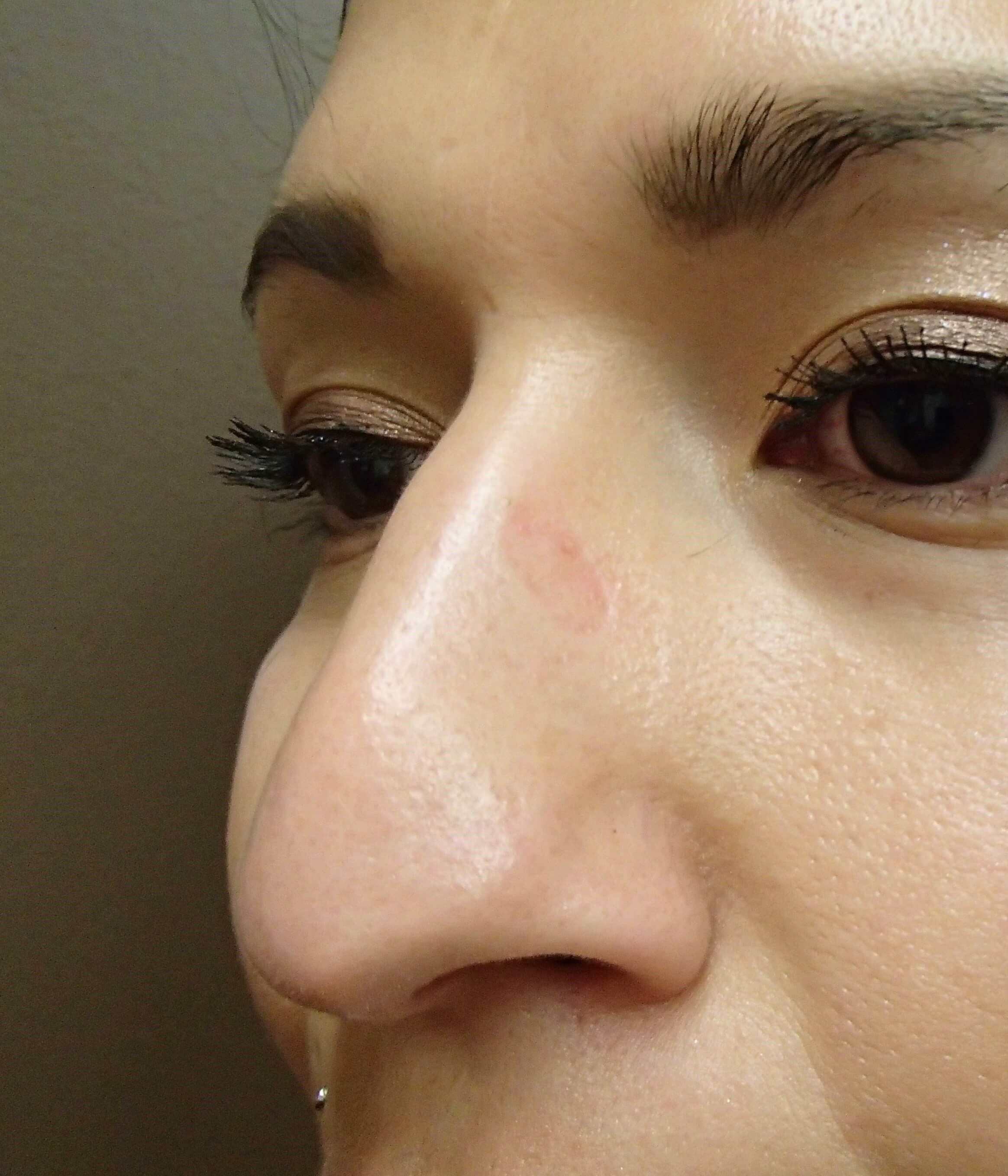 Rhinoplasty Before