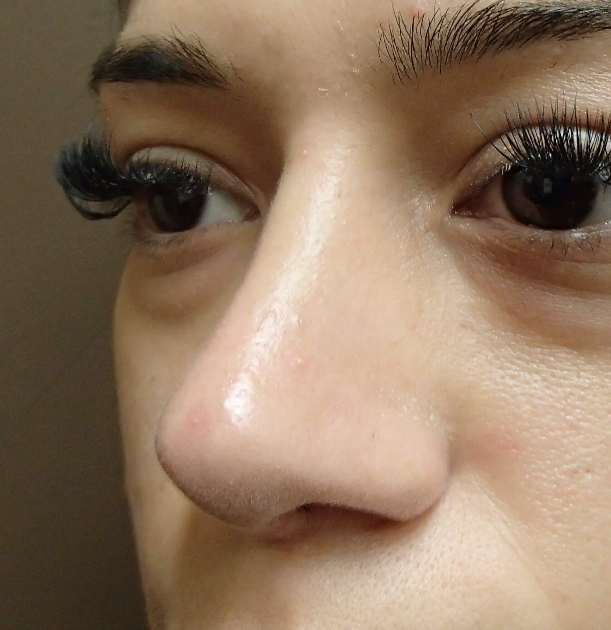 Rhinoplasty After