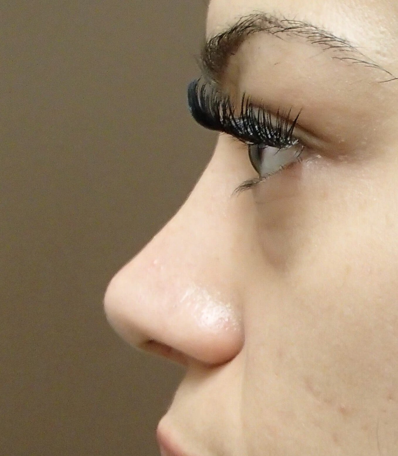 Rhinoplasty After